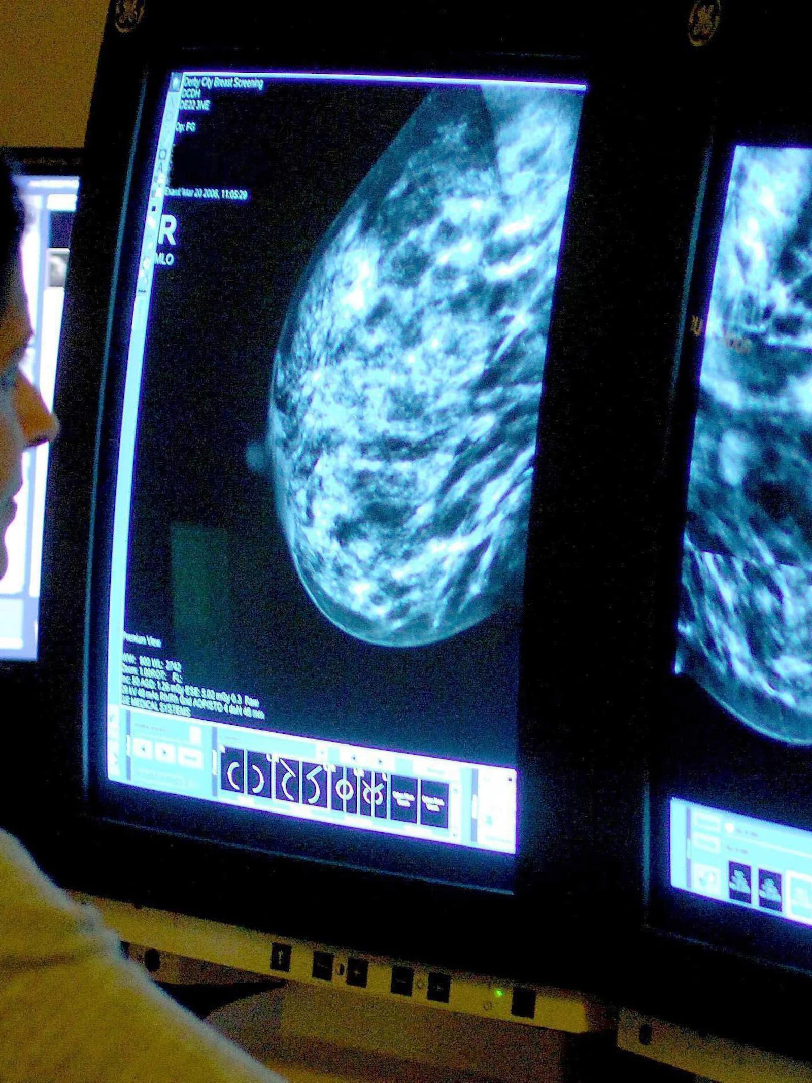 Chemotherapie bij borstkanker vaak overbodig