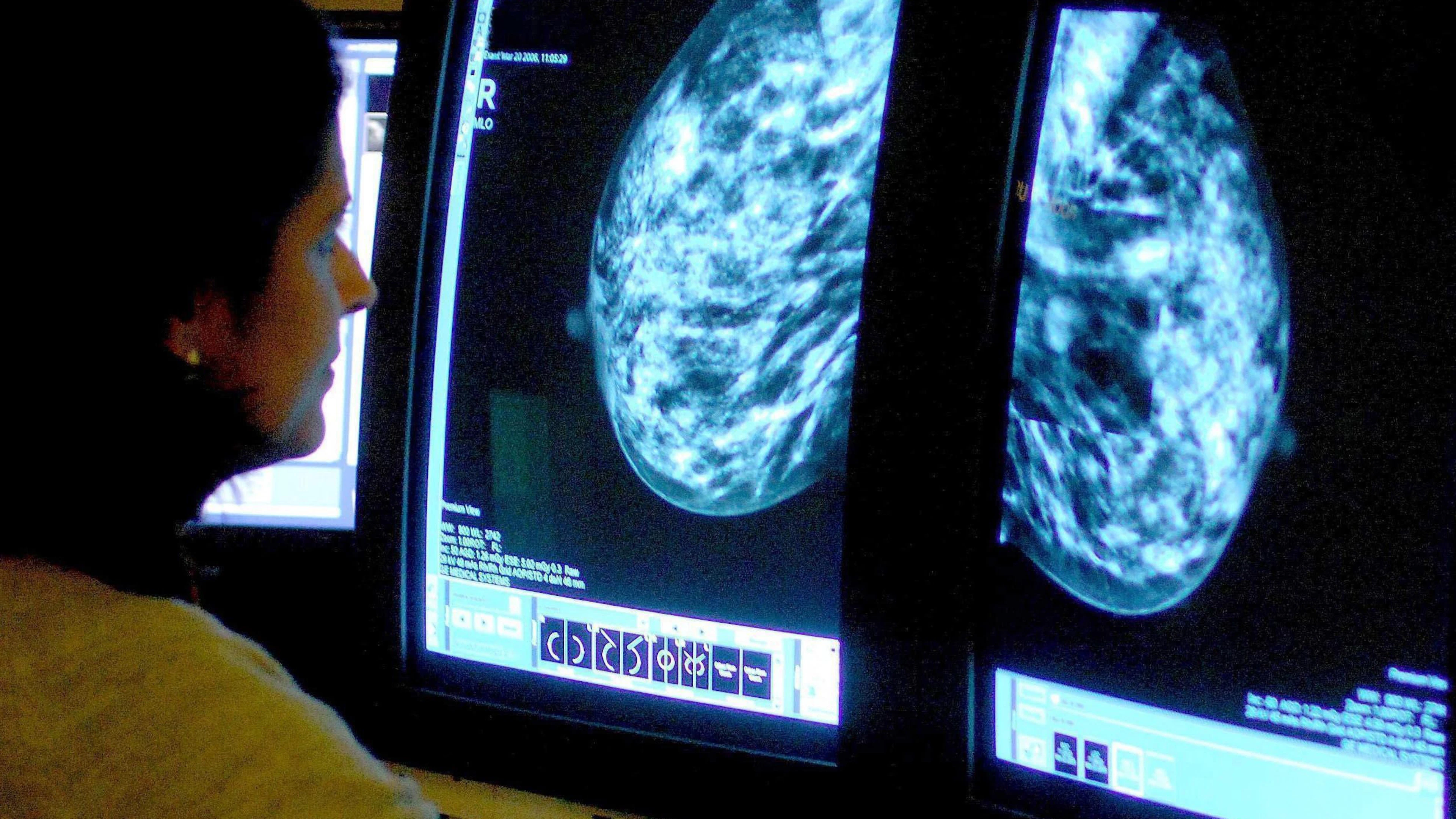 Chemotherapie bij borstkanker vaak overbodig