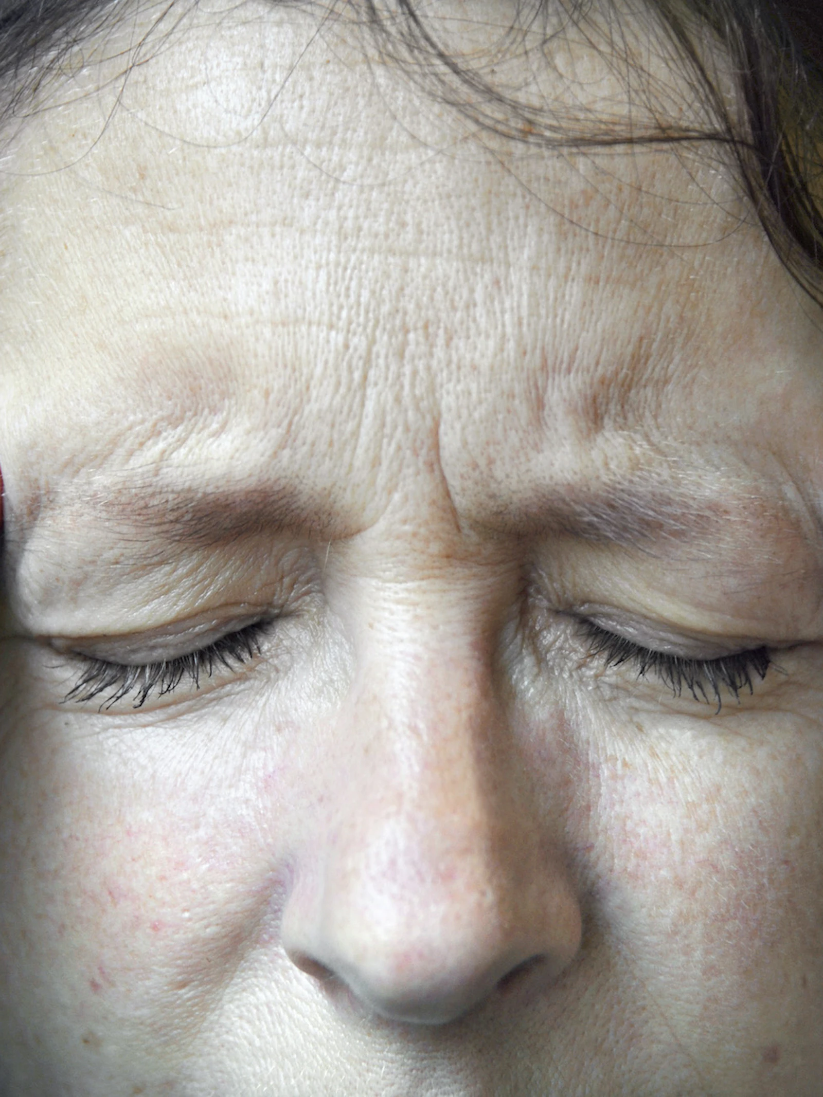 Nieuwe remedies tegen migraine en clusterhoofdpijn