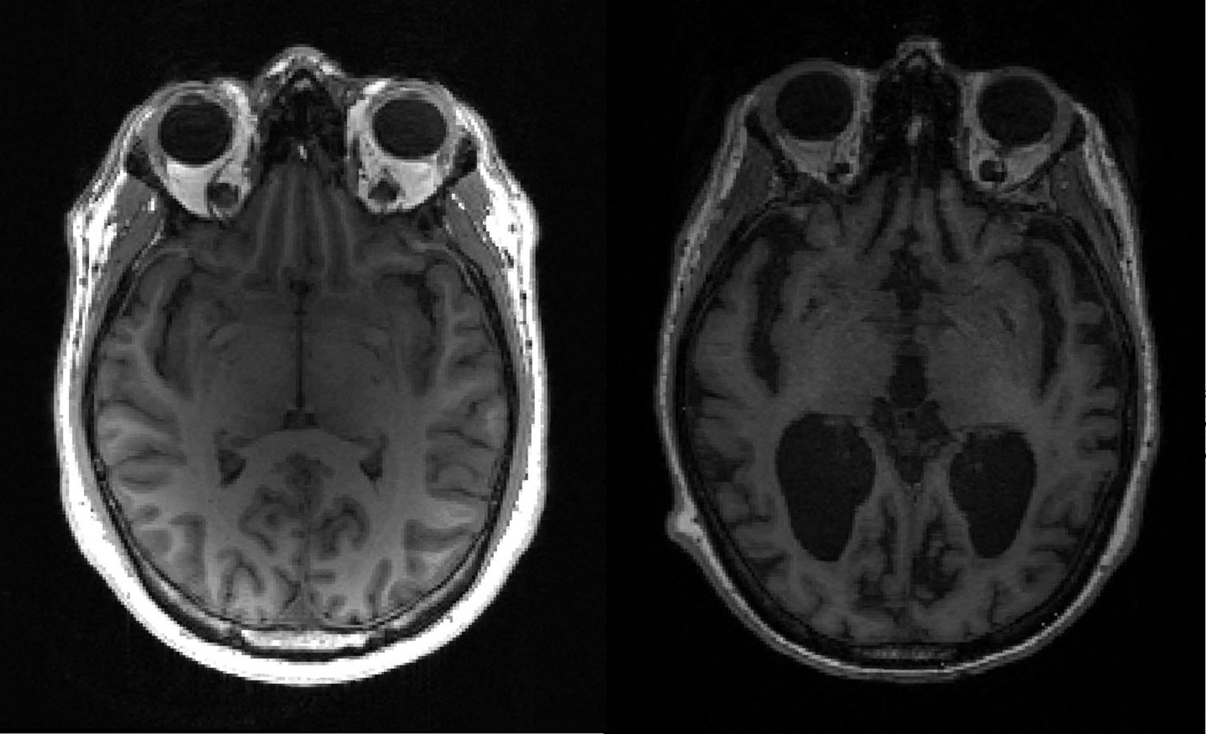 Zo ziet het verloop van alzheimer er in het brein uit