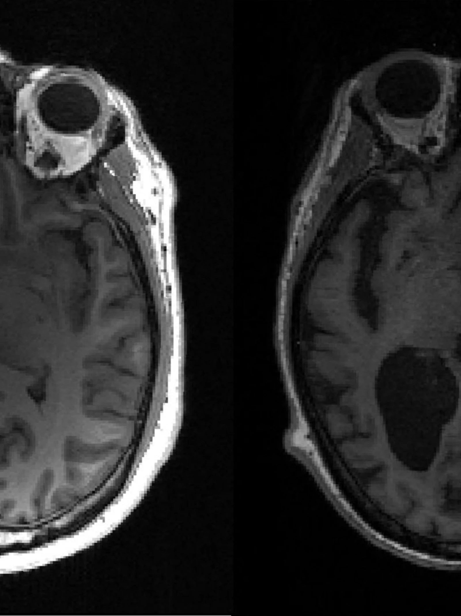 Zo ziet het verloop van alzheimer er in het brein uit