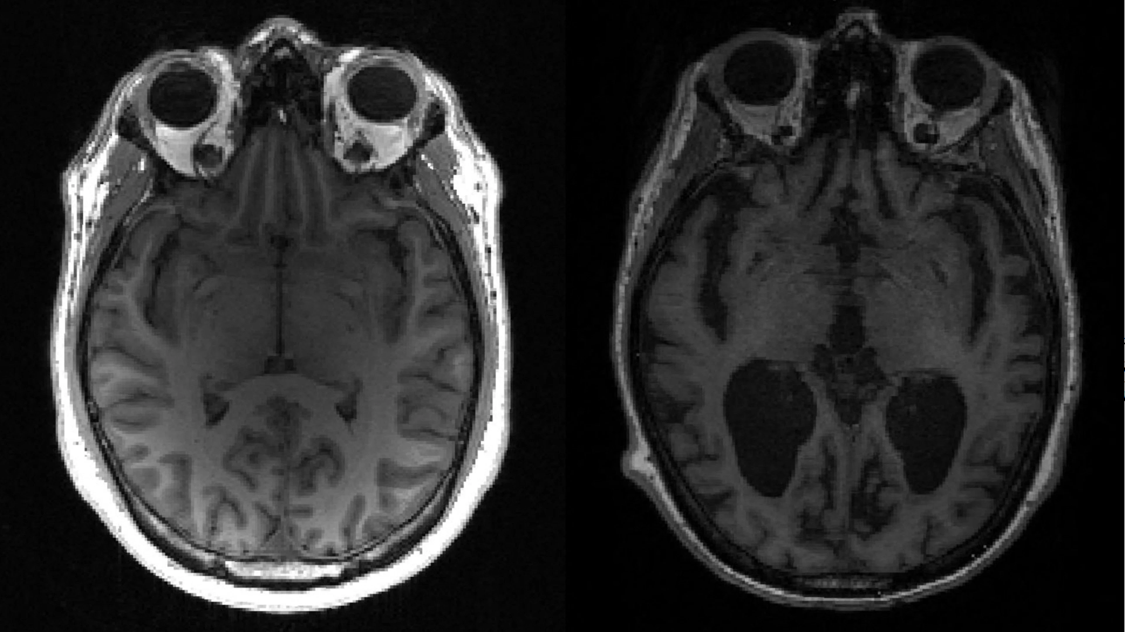 Zo ziet het verloop van alzheimer er in het brein uit