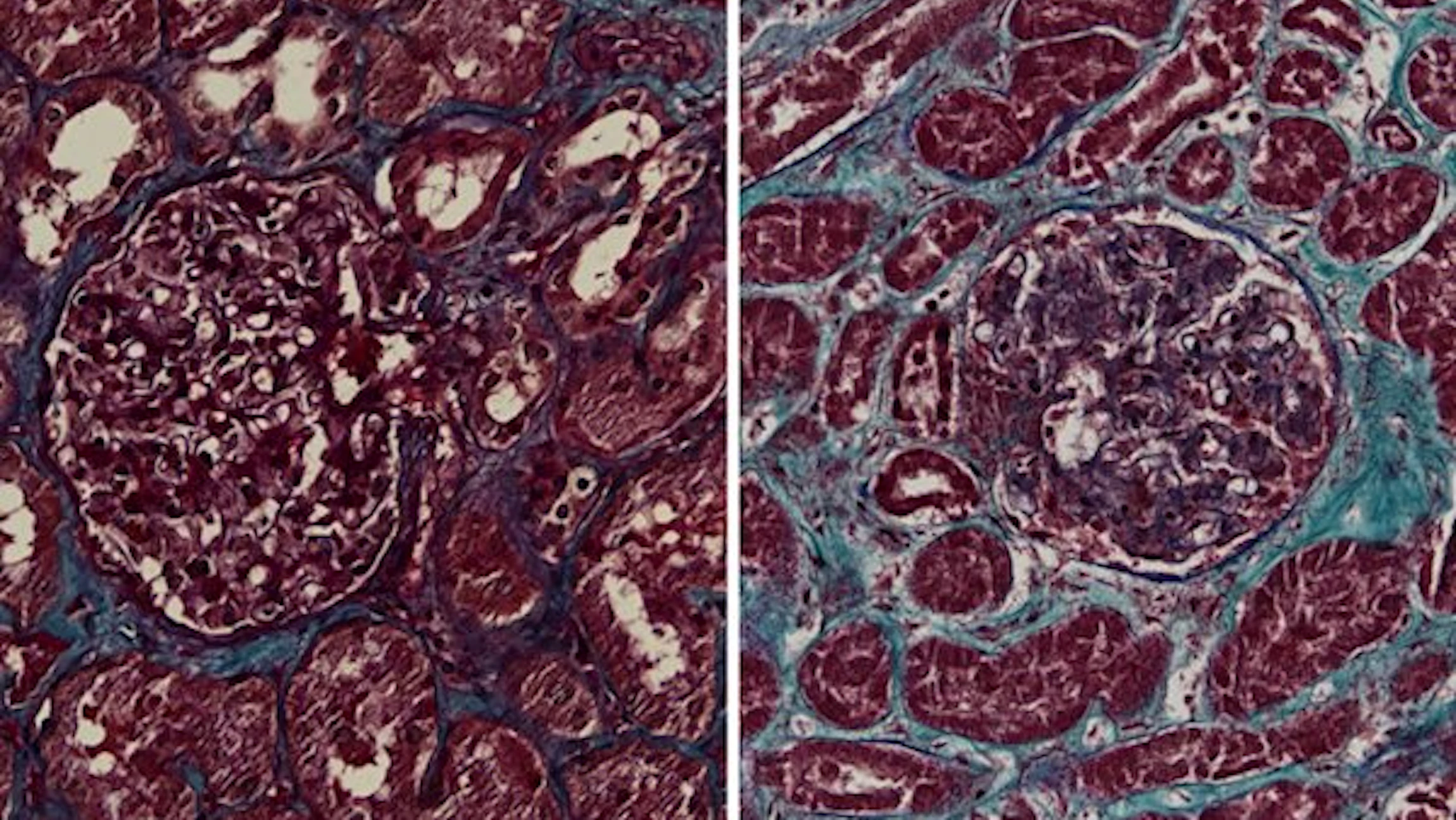 Het coronavirus valt ook de nieren aan