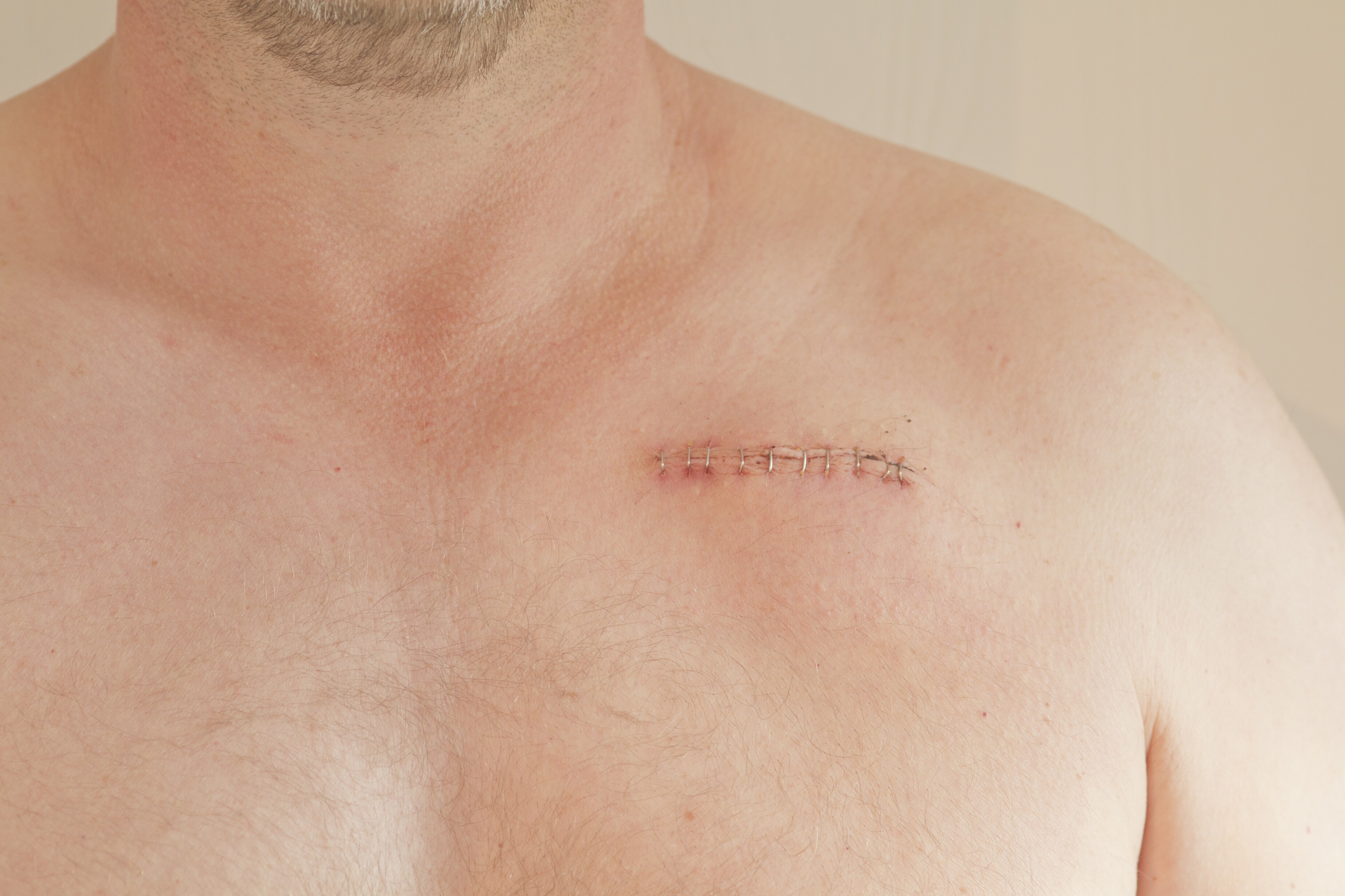 Nieuwe pacemaker bootst natuurlijk hartritme na