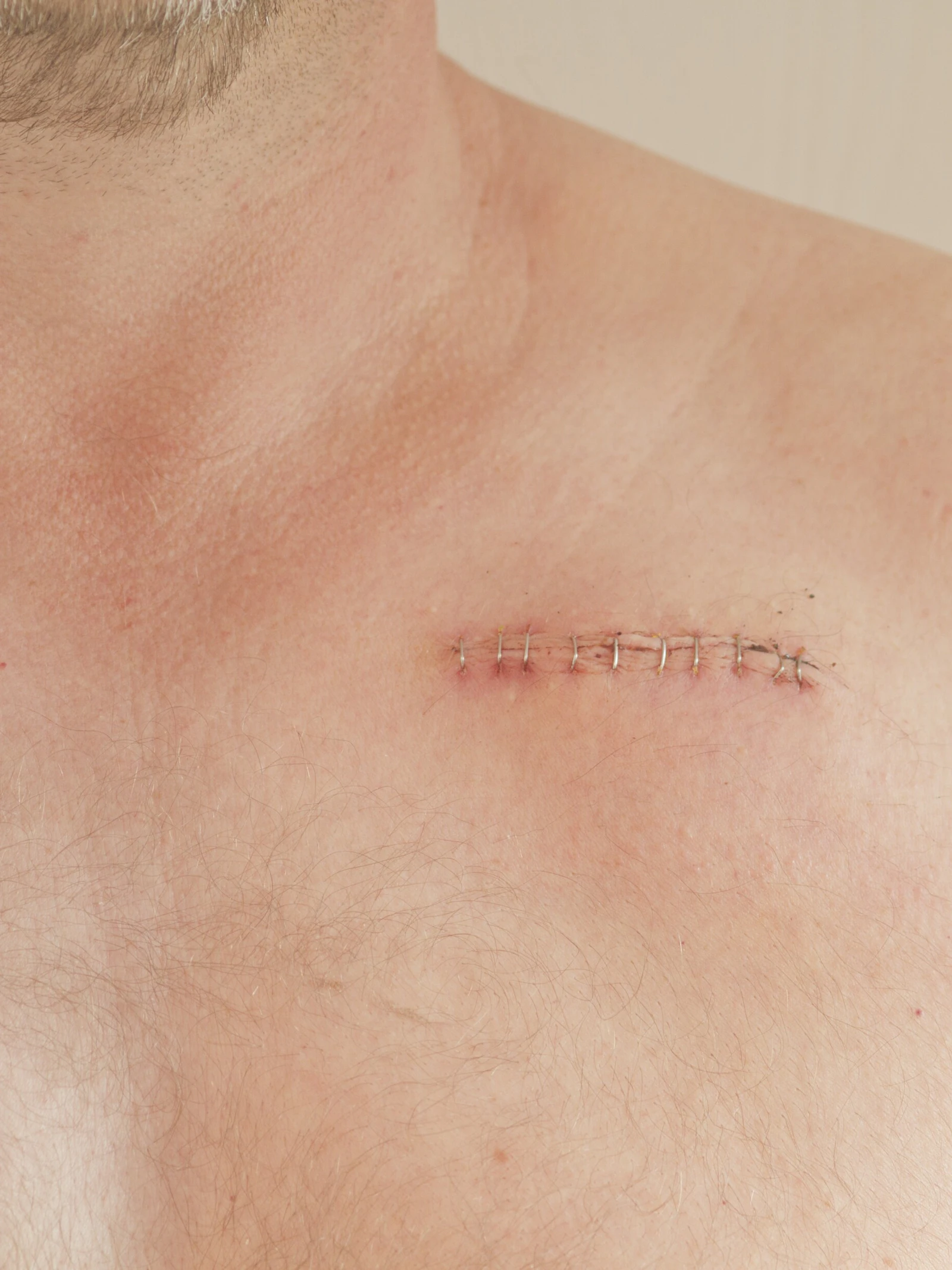 Nieuwe pacemaker bootst natuurlijk hartritme na