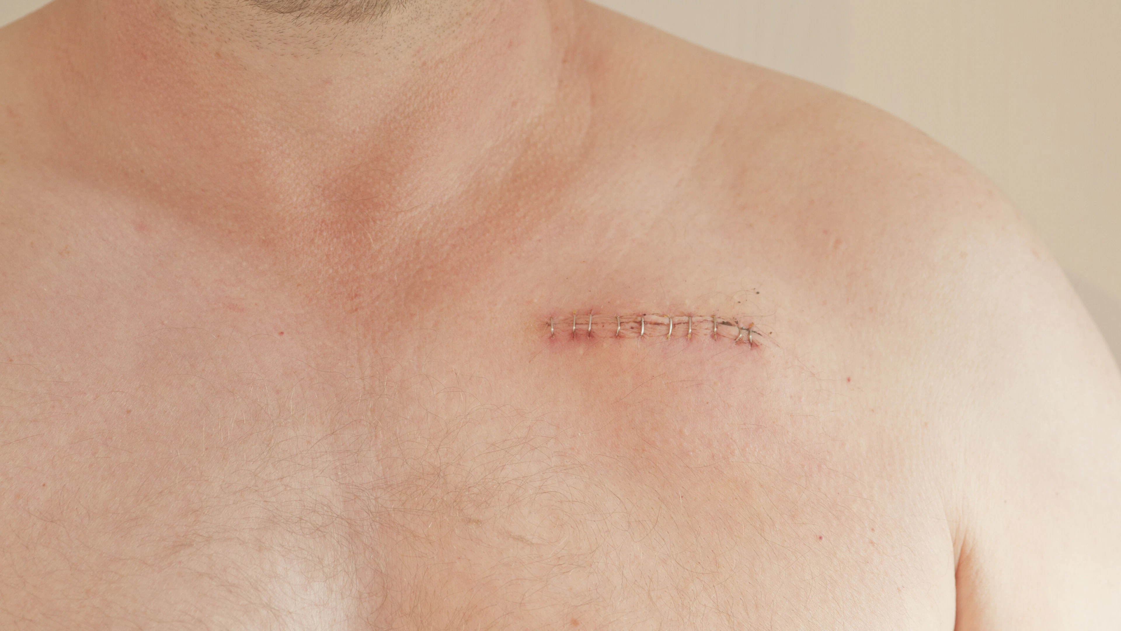 Nieuwe pacemaker bootst natuurlijk hartritme na