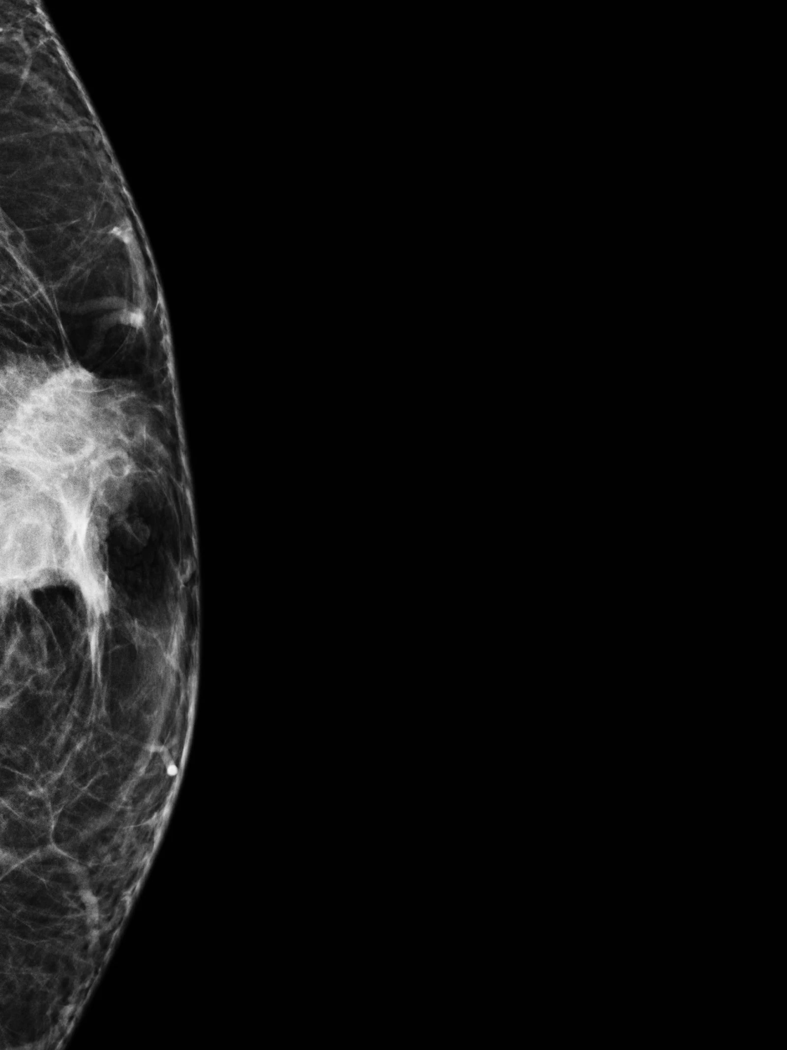 De tumor die niemand opmerkt