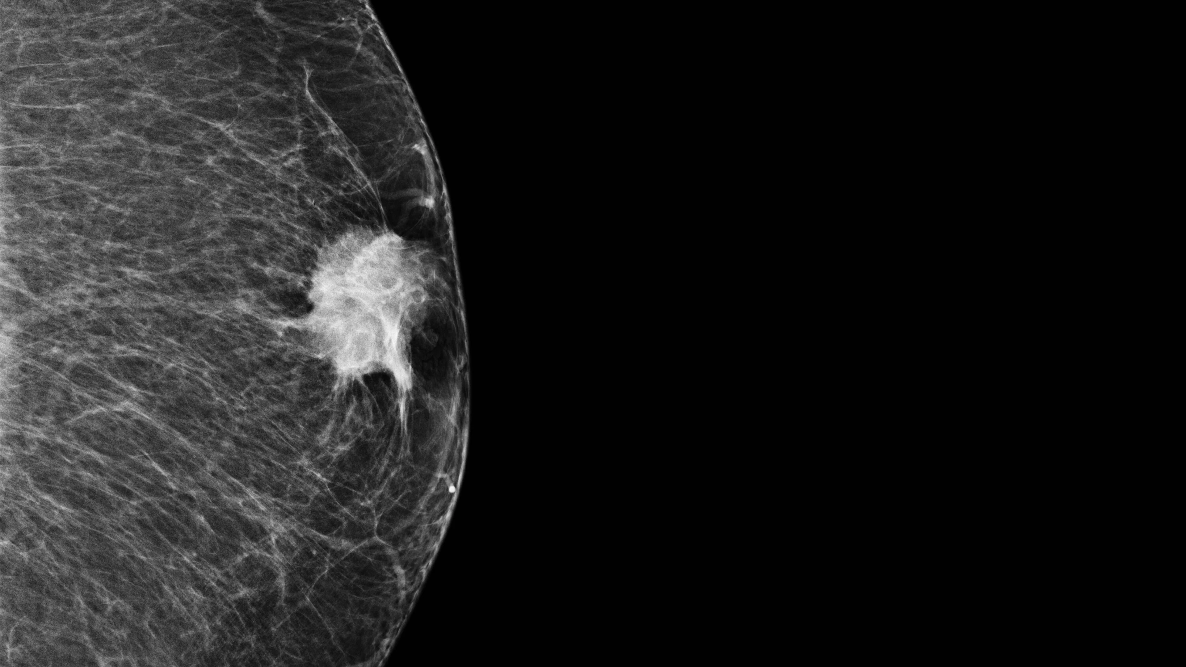 De tumor die niemand opmerkt