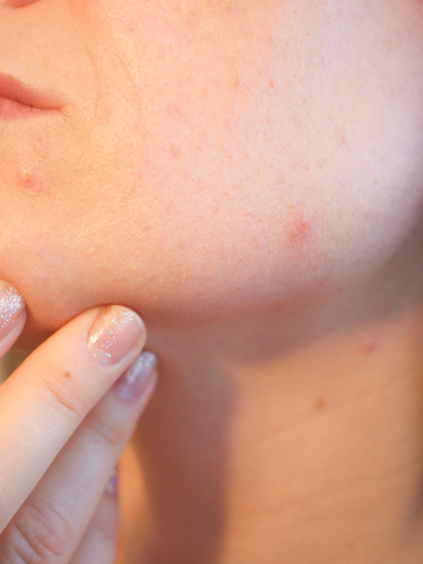 Helpt een crème met probiotica tegen acne?