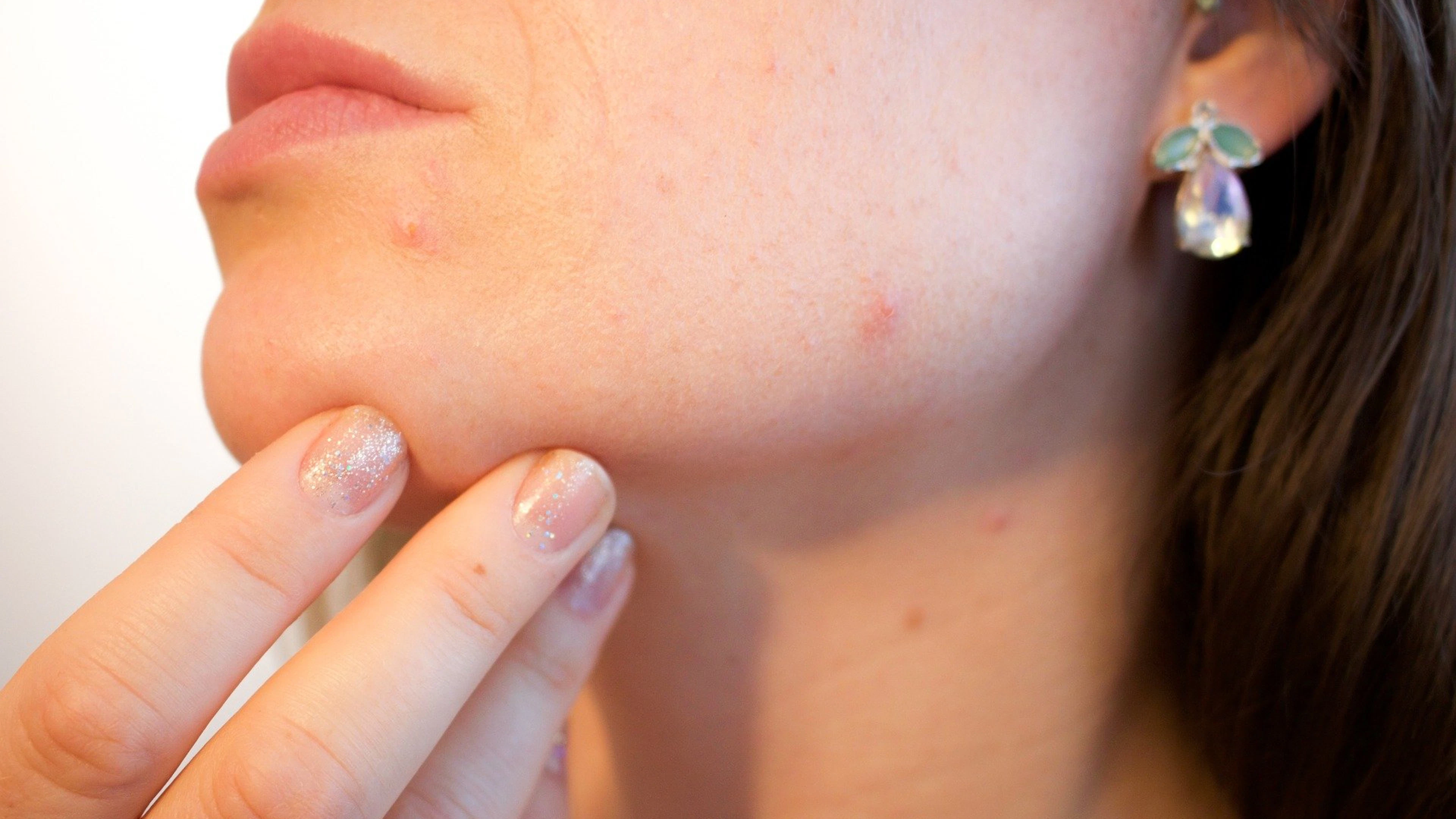 Helpt een crème met probiotica tegen acne?