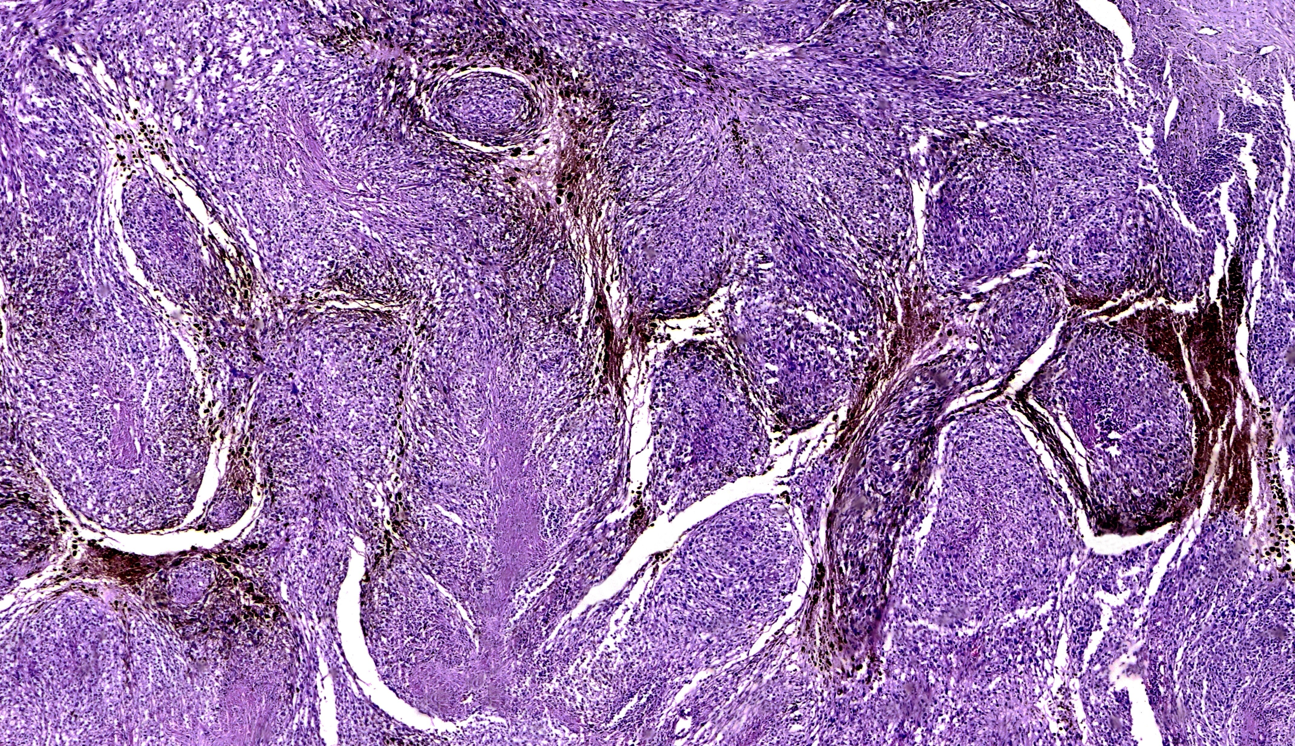 Immunotherapie biedt kans op genezing van uitgezaaid melanoom