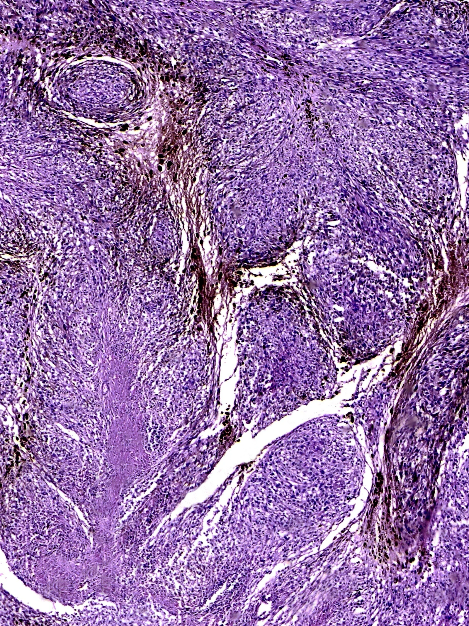 Immunotherapie biedt kans op genezing van uitgezaaid melanoom