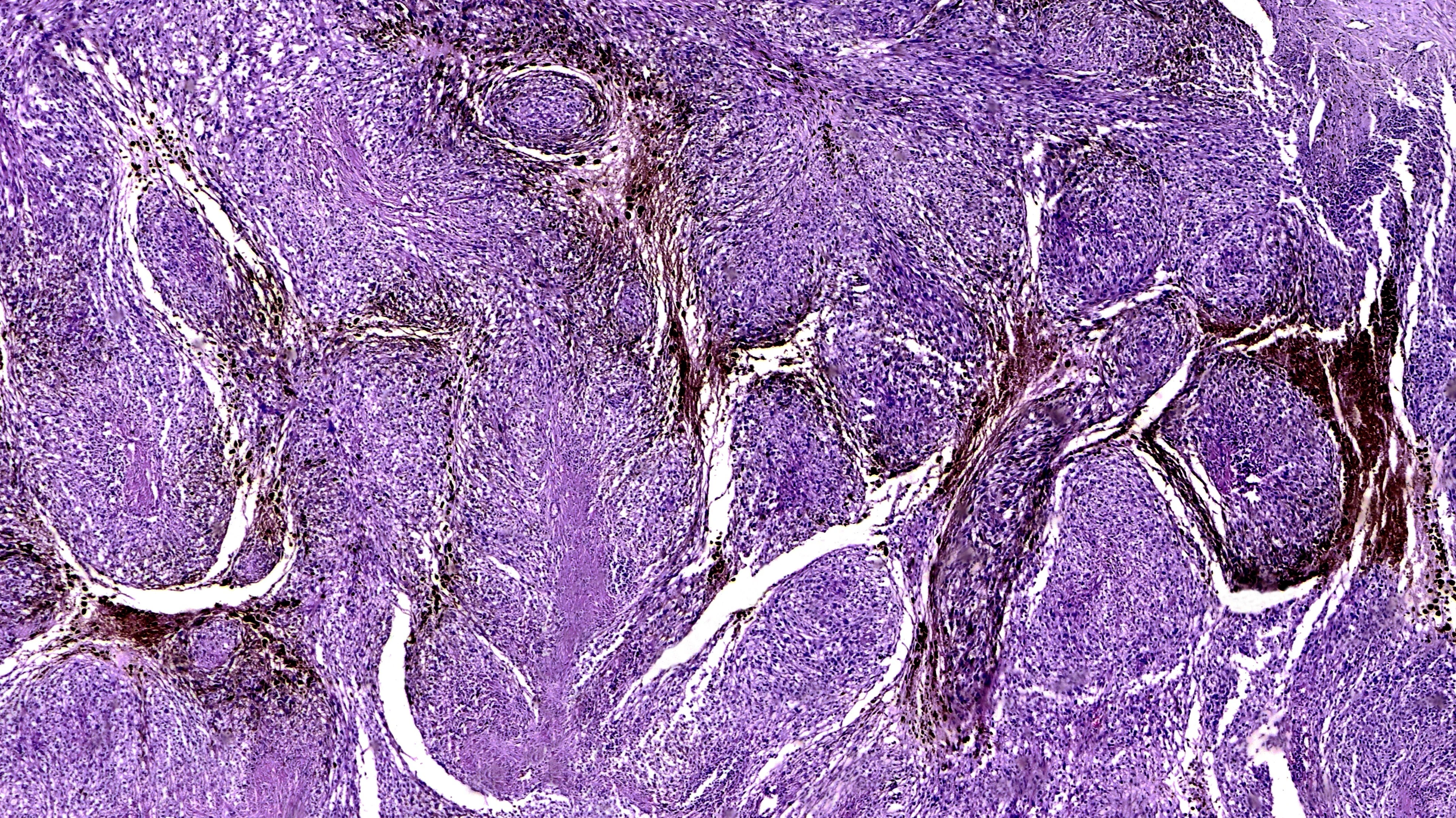 Immunotherapie biedt kans op genezing van uitgezaaid melanoom
