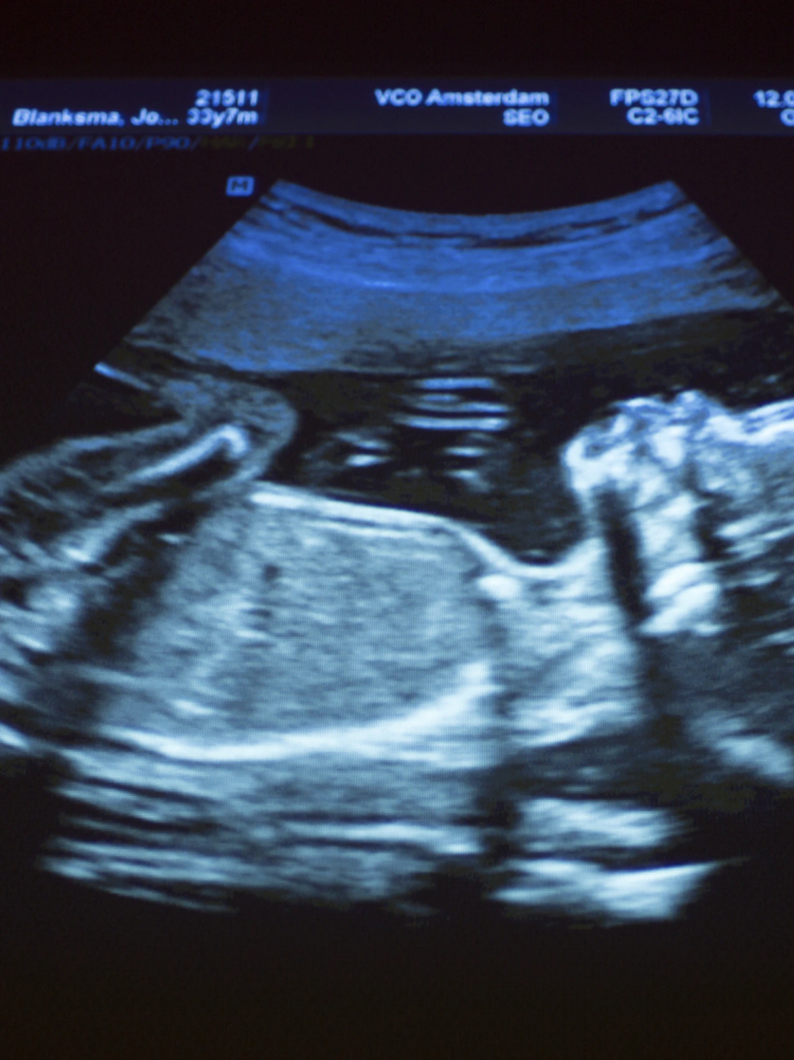 Ongeboren baby’s hebben al roet in hun longen, lever en hersenen