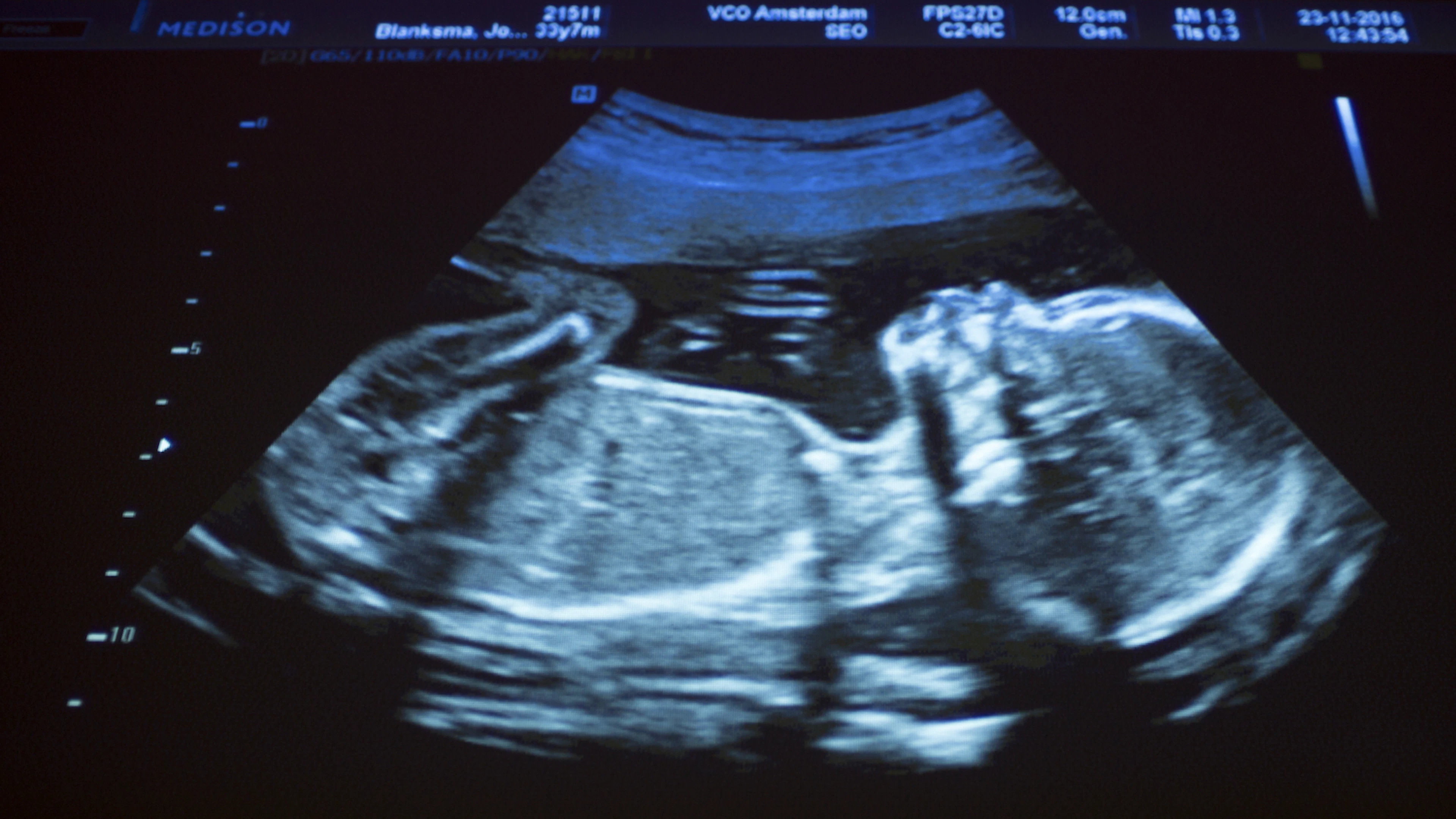 Ongeboren baby’s hebben al roet in hun longen, lever en hersenen