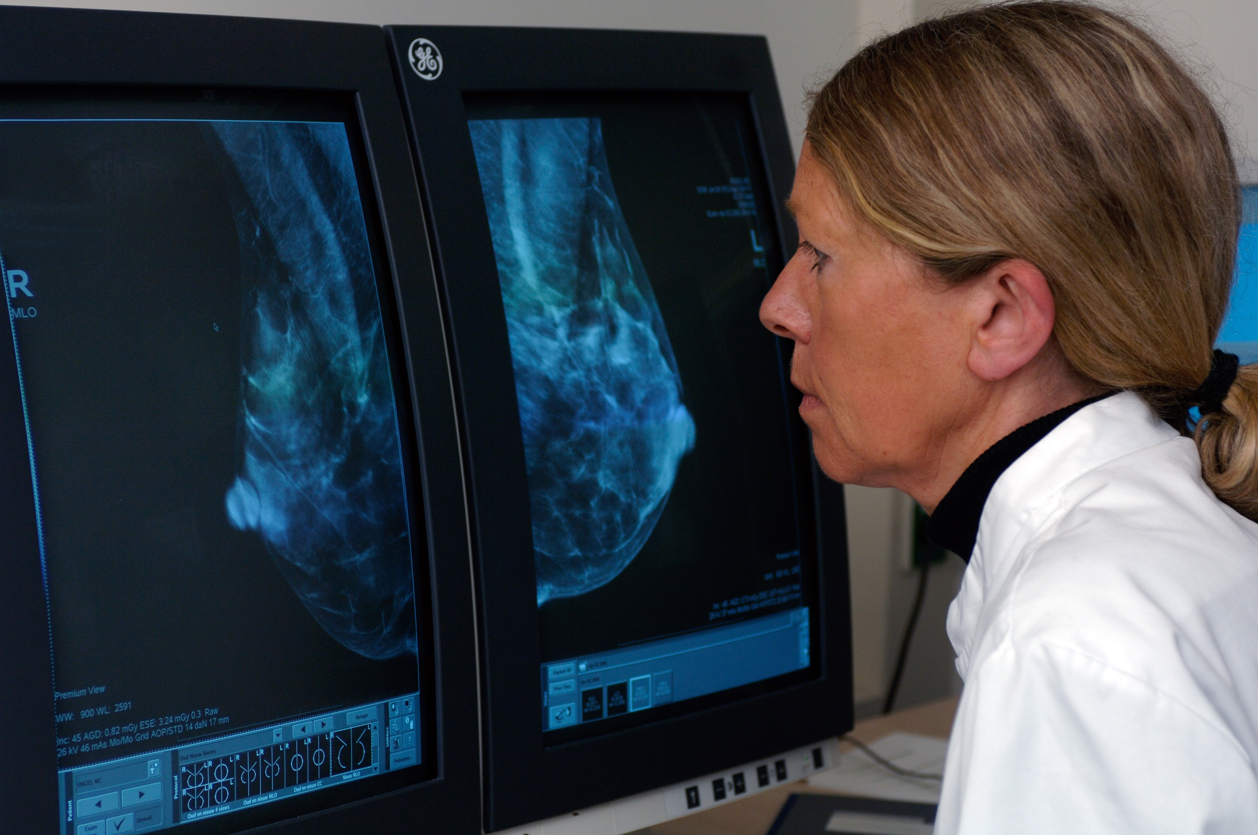 Kan een echografie een mammografie vervangen bij de beoordeling van een knobbeltje in de borst?