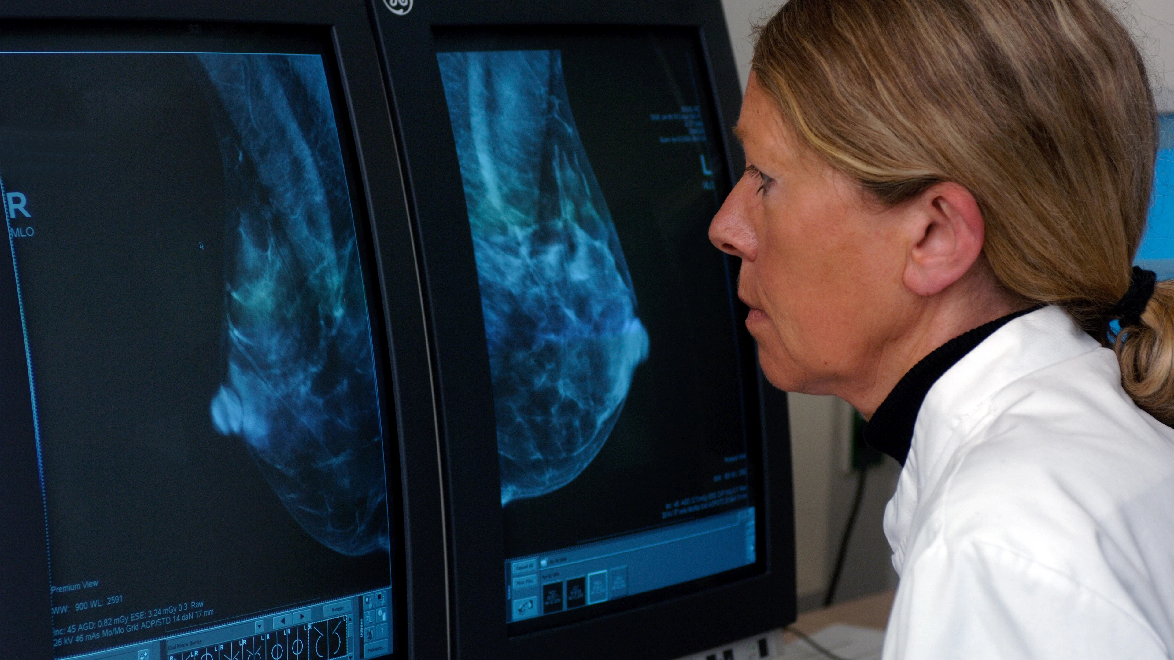 Kan een echografie een mammografie vervangen bij de beoordeling van een knobbeltje in de borst?