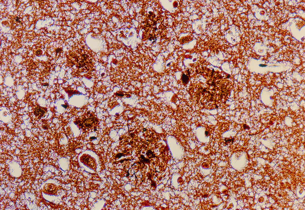 Slaapgebrek verergert de ziekte van Alzheimer bij muizen