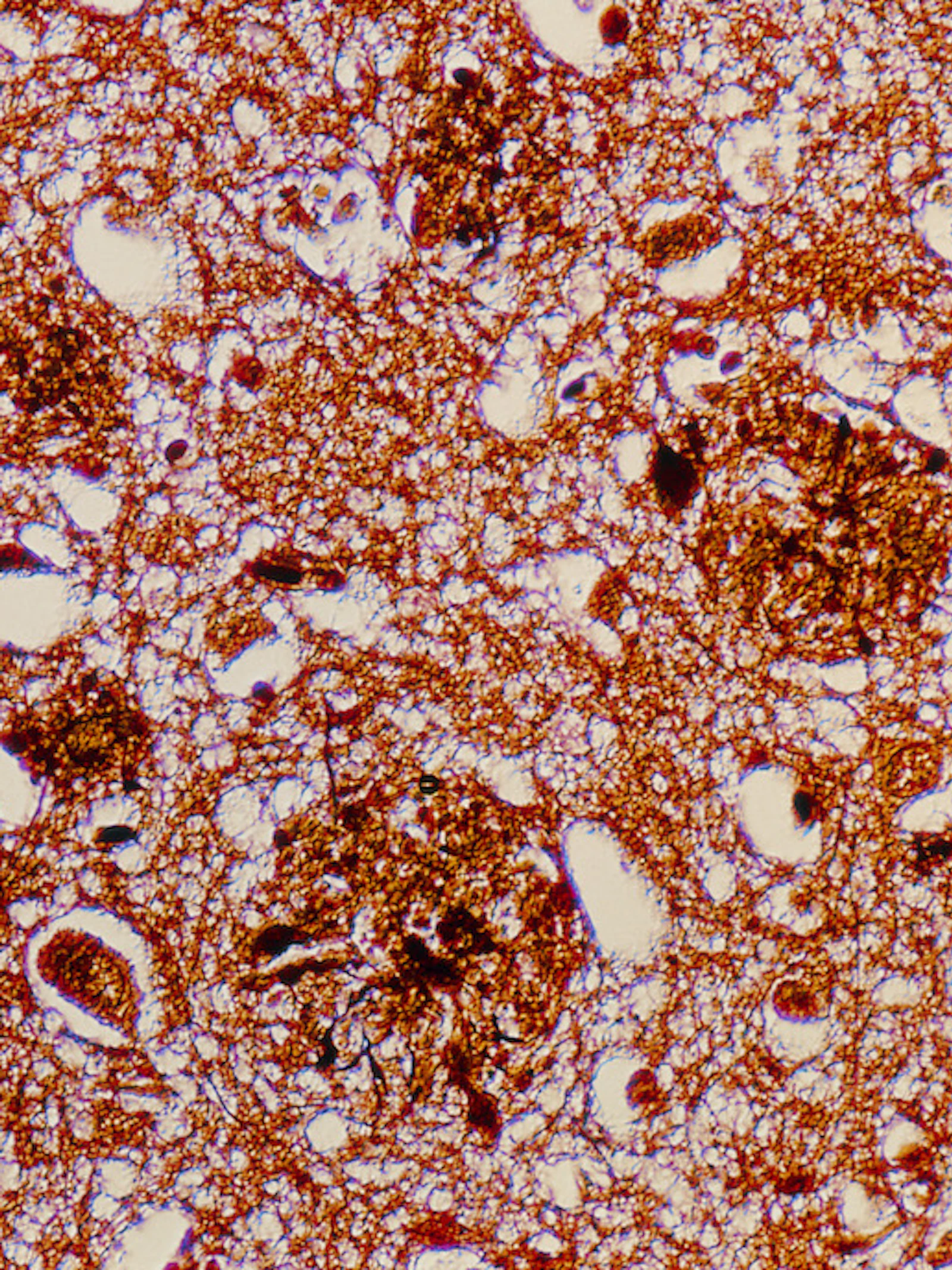 Slaapgebrek verergert de ziekte van Alzheimer bij muizen