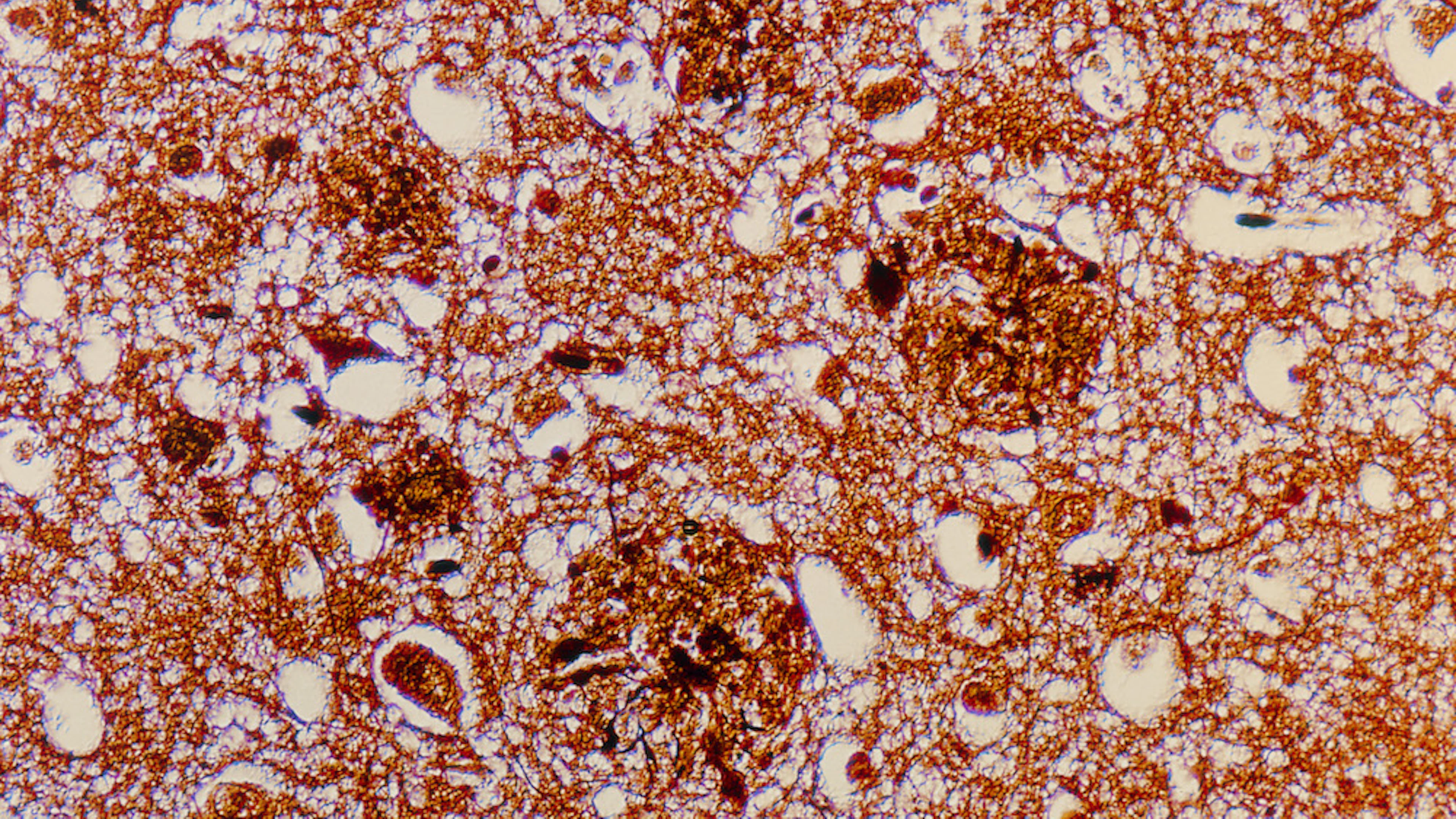 Slaapgebrek verergert de ziekte van Alzheimer bij muizen