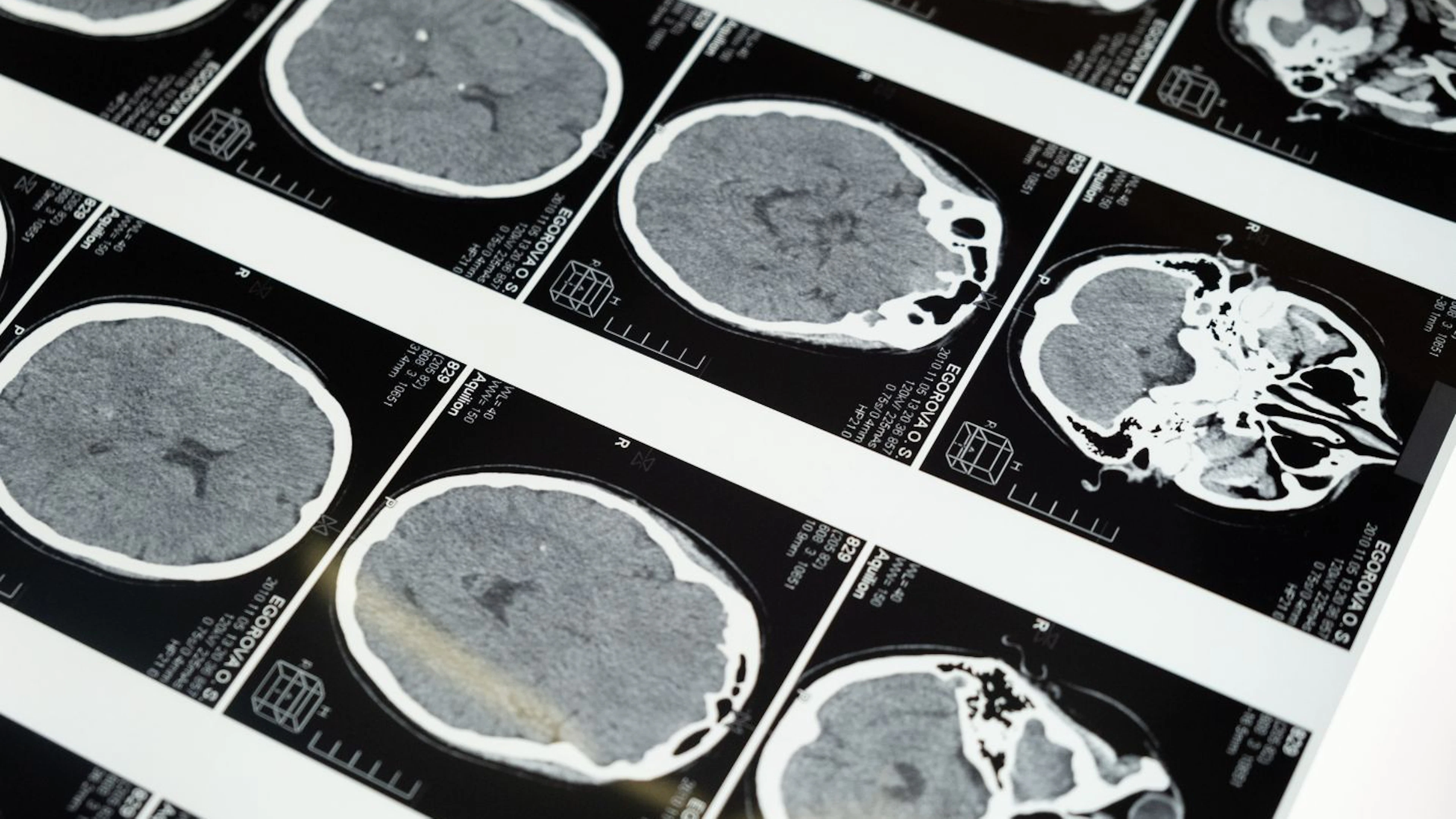 Kankermedicijnen geraken eindelijk voorbij de bloed-hersenbarrière