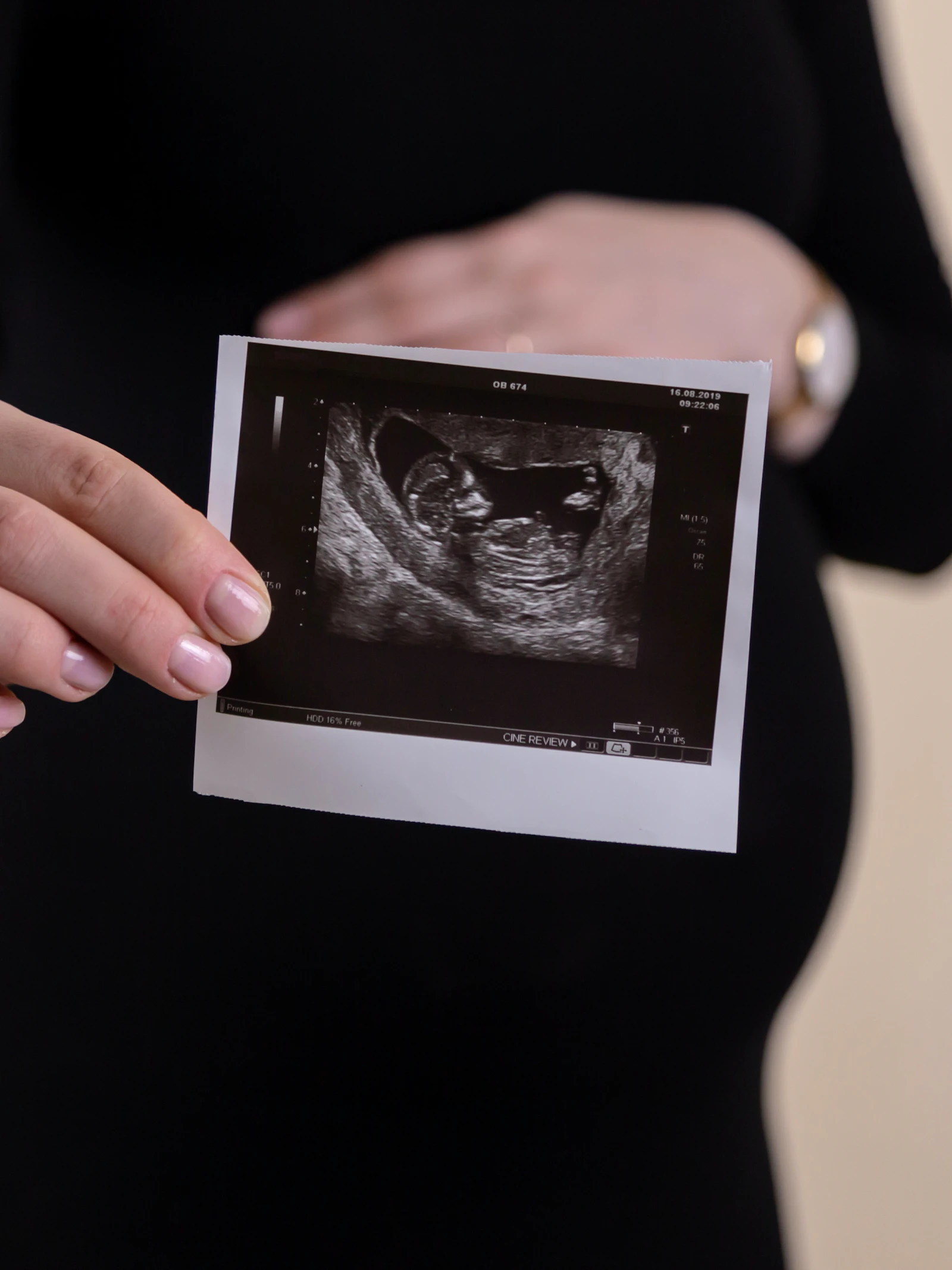 Ongeboren baby bestuurt metabolisme van moeder dankzij 'hebzuchtig' gen van vader
