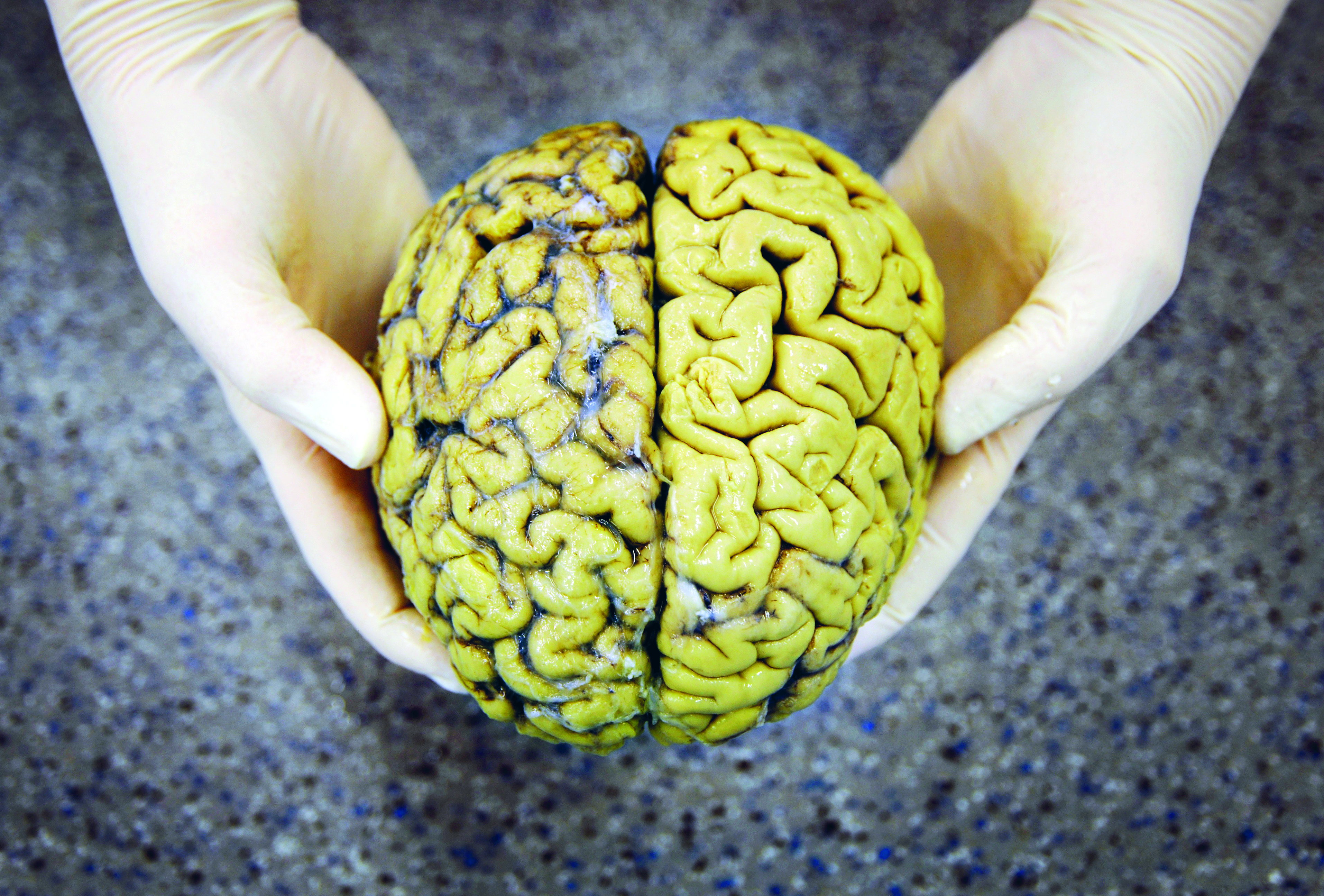 Hoe alzheimeronderzoek op een doodlopend spoor terecht kwam