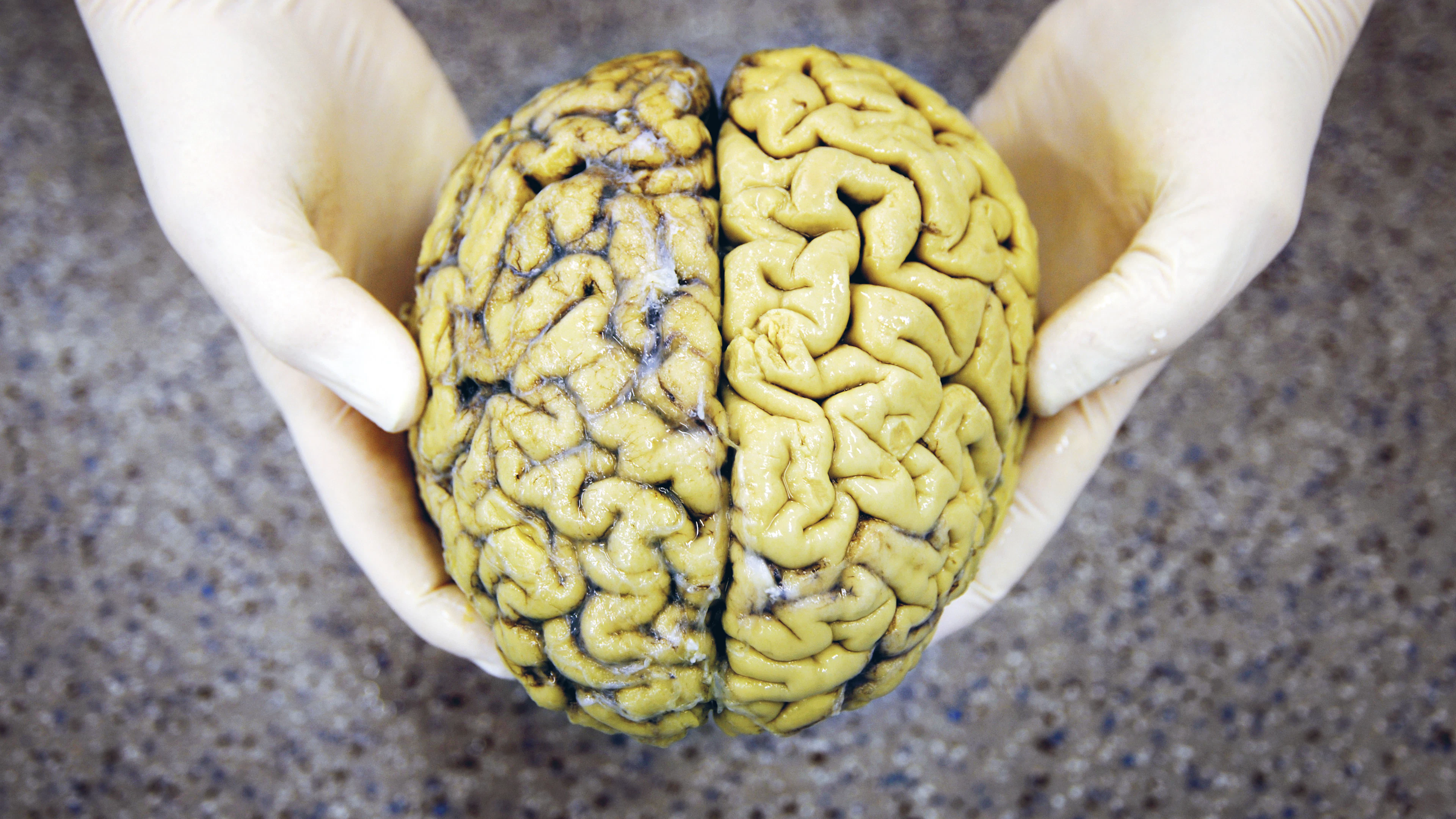 Hoe alzheimeronderzoek op een doodlopend spoor terecht kwam