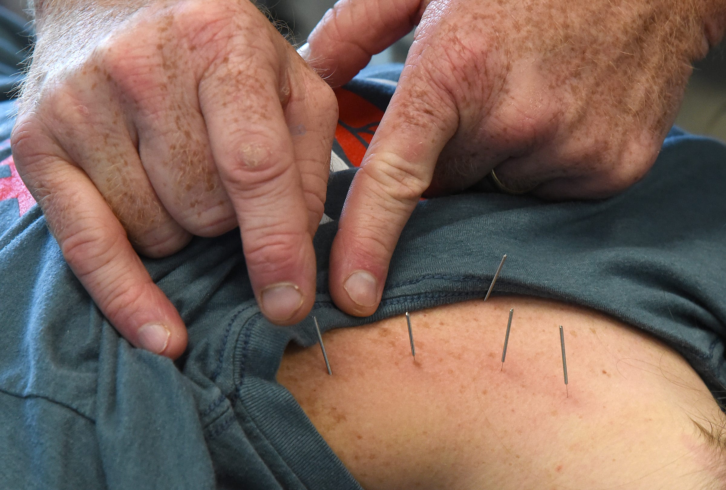 Hoe wetenschappelijk is dry needling, de ‘acupunctuur van de kinesist’?