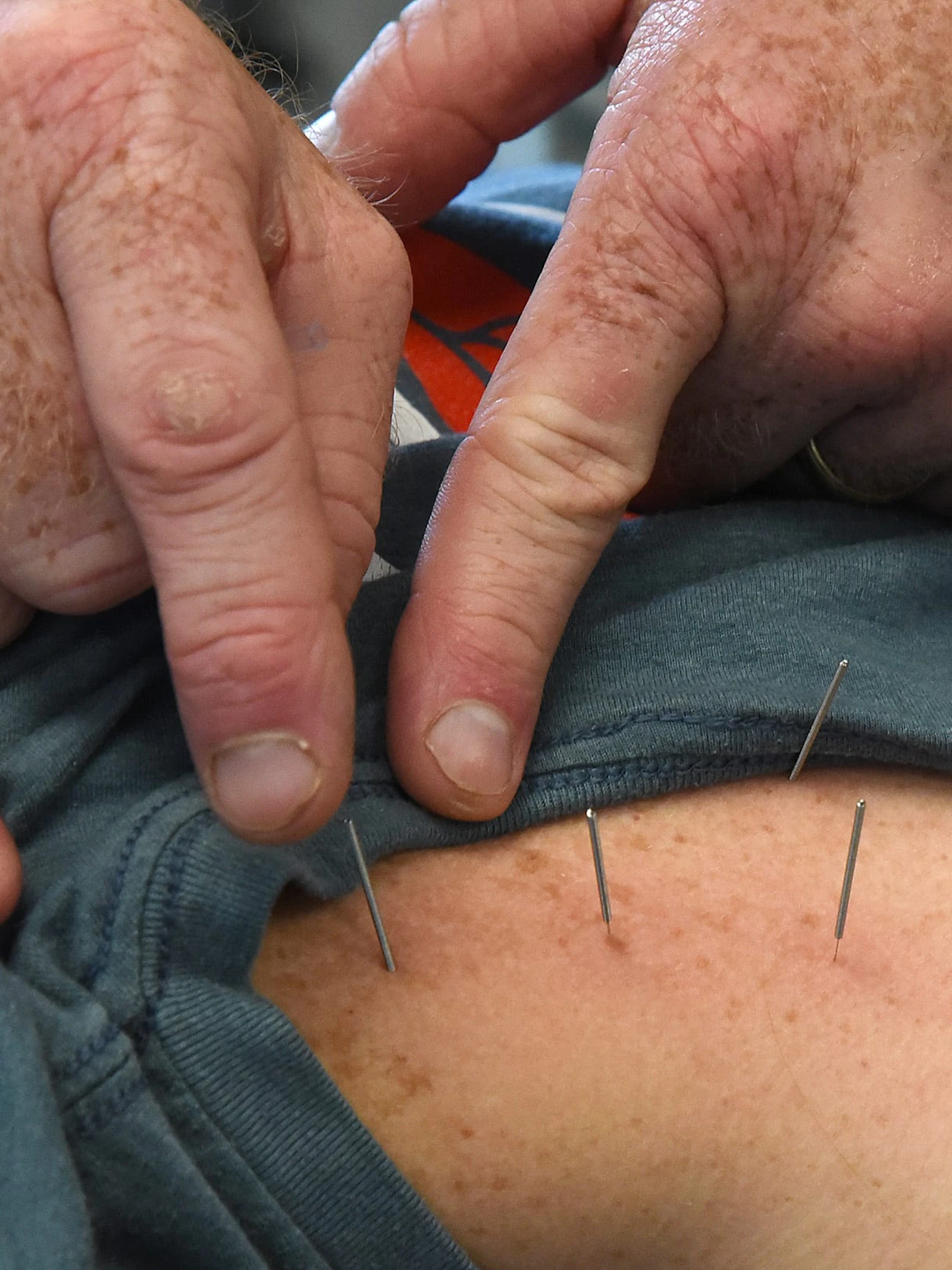 Hoe wetenschappelijk is dry needling, de ‘acupunctuur van de kinesist’?