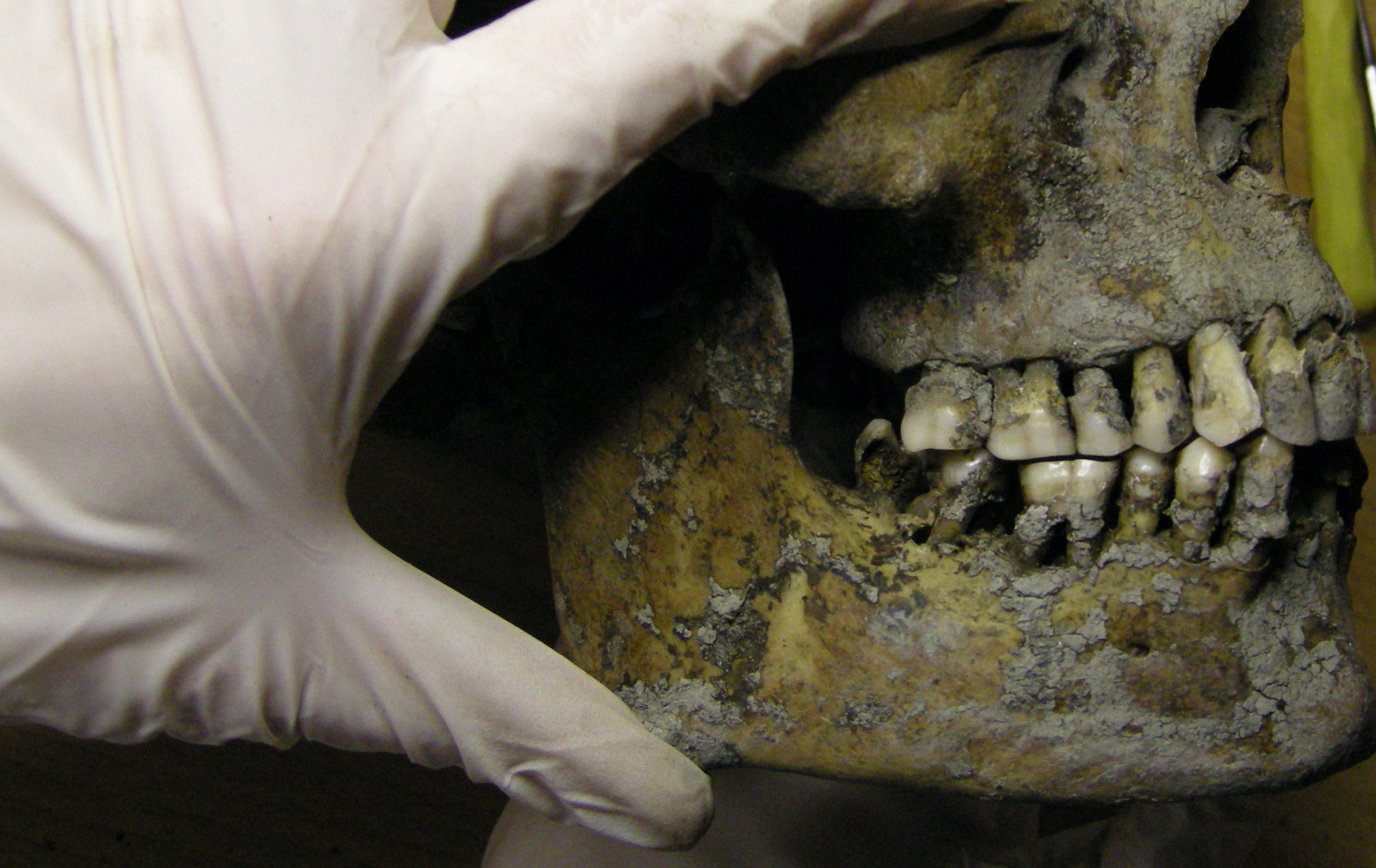 De Vikingen waren verrassend goede tandartsen