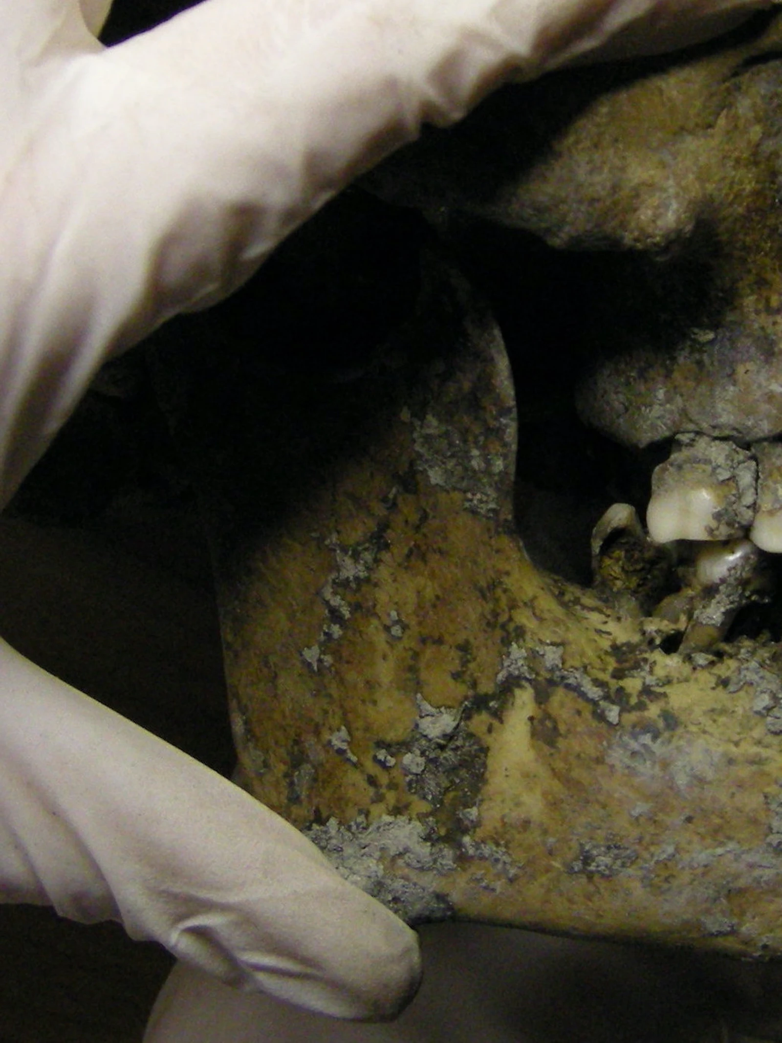 De Vikingen waren verrassend goede tandartsen