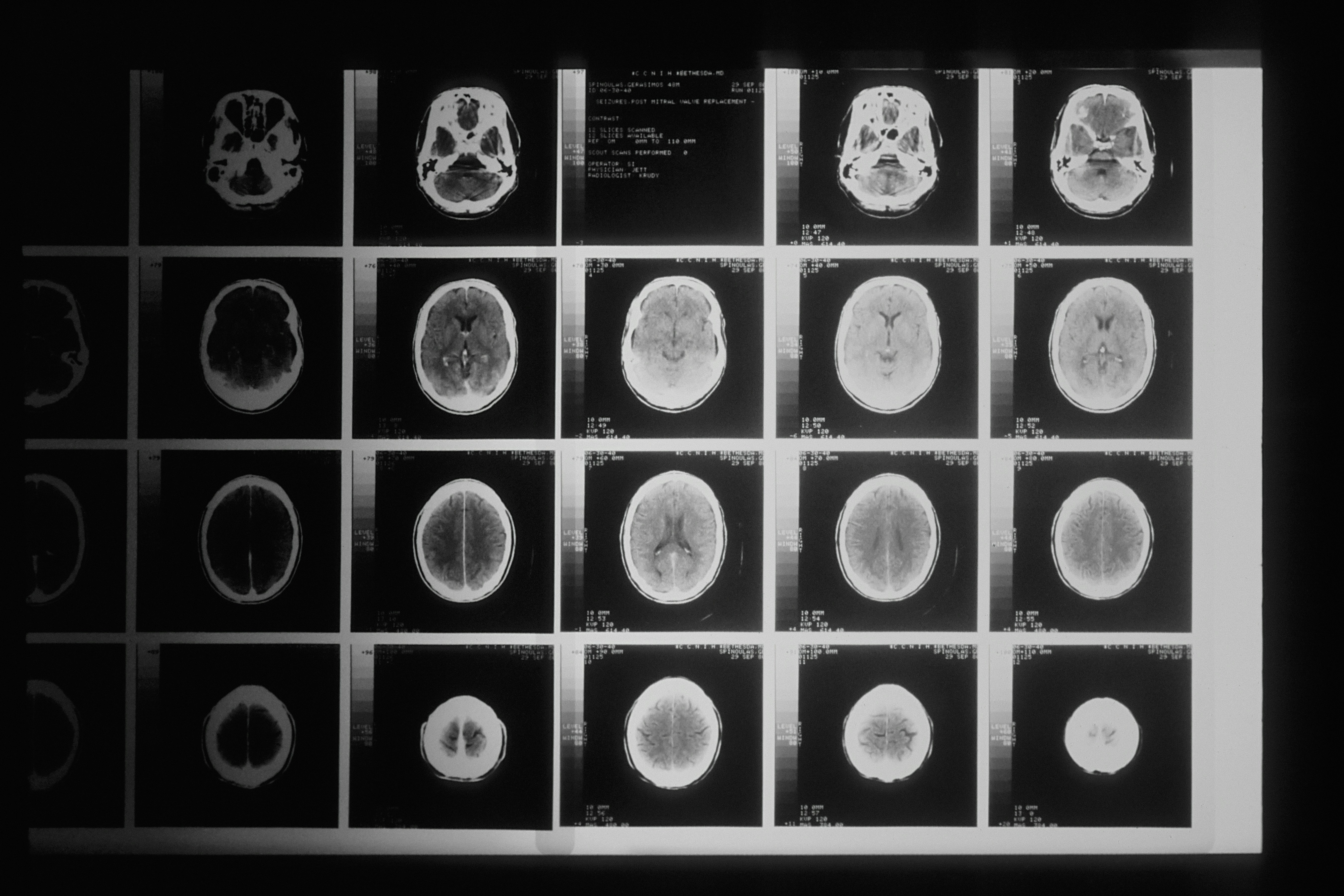 Nieuw mRNA-kankervaccin activeert felle immuunrespons tegen kwaadaardige hersentumoren