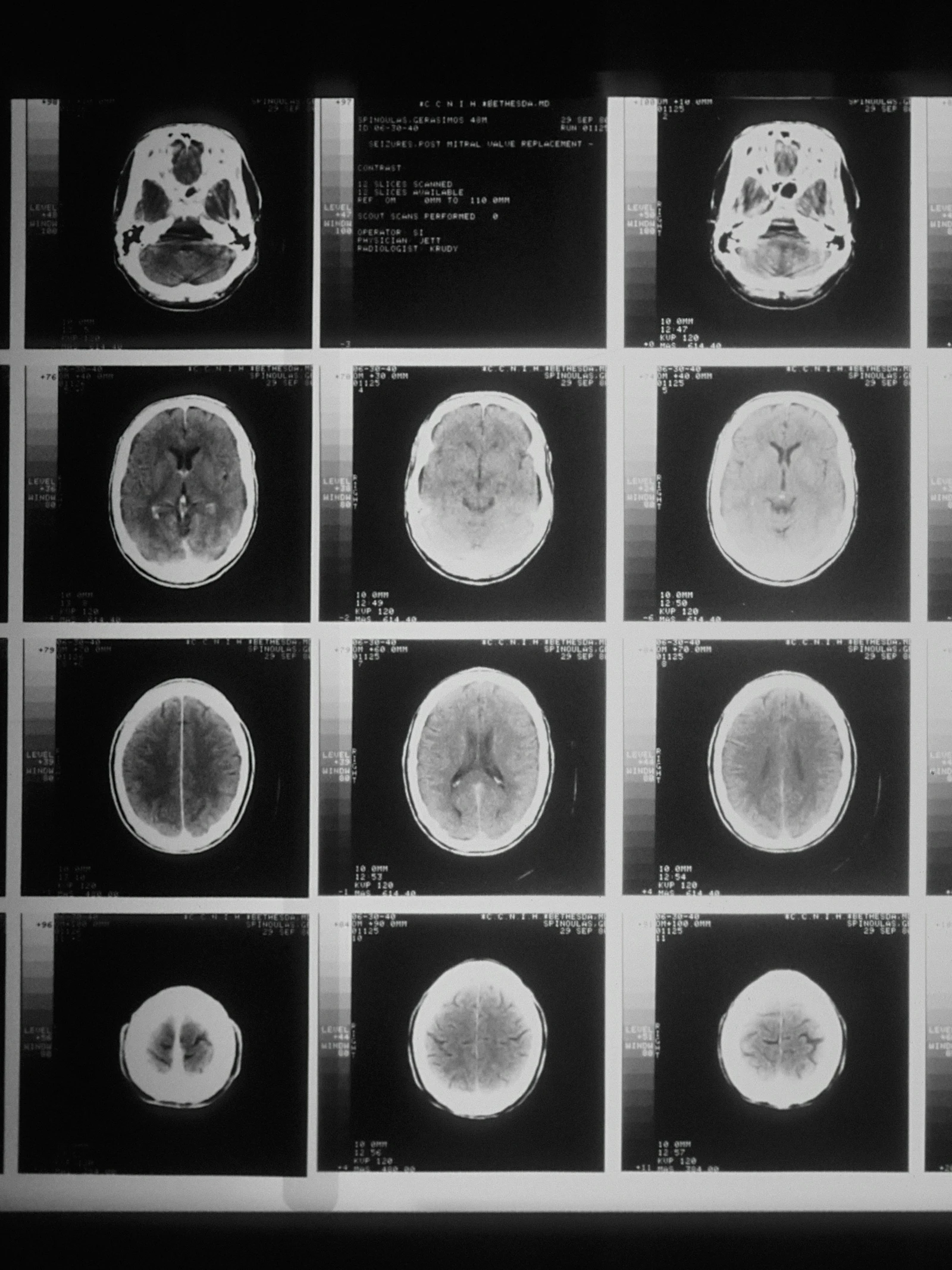 Nieuw mRNA-kankervaccin activeert felle immuunrespons tegen kwaadaardige hersentumoren