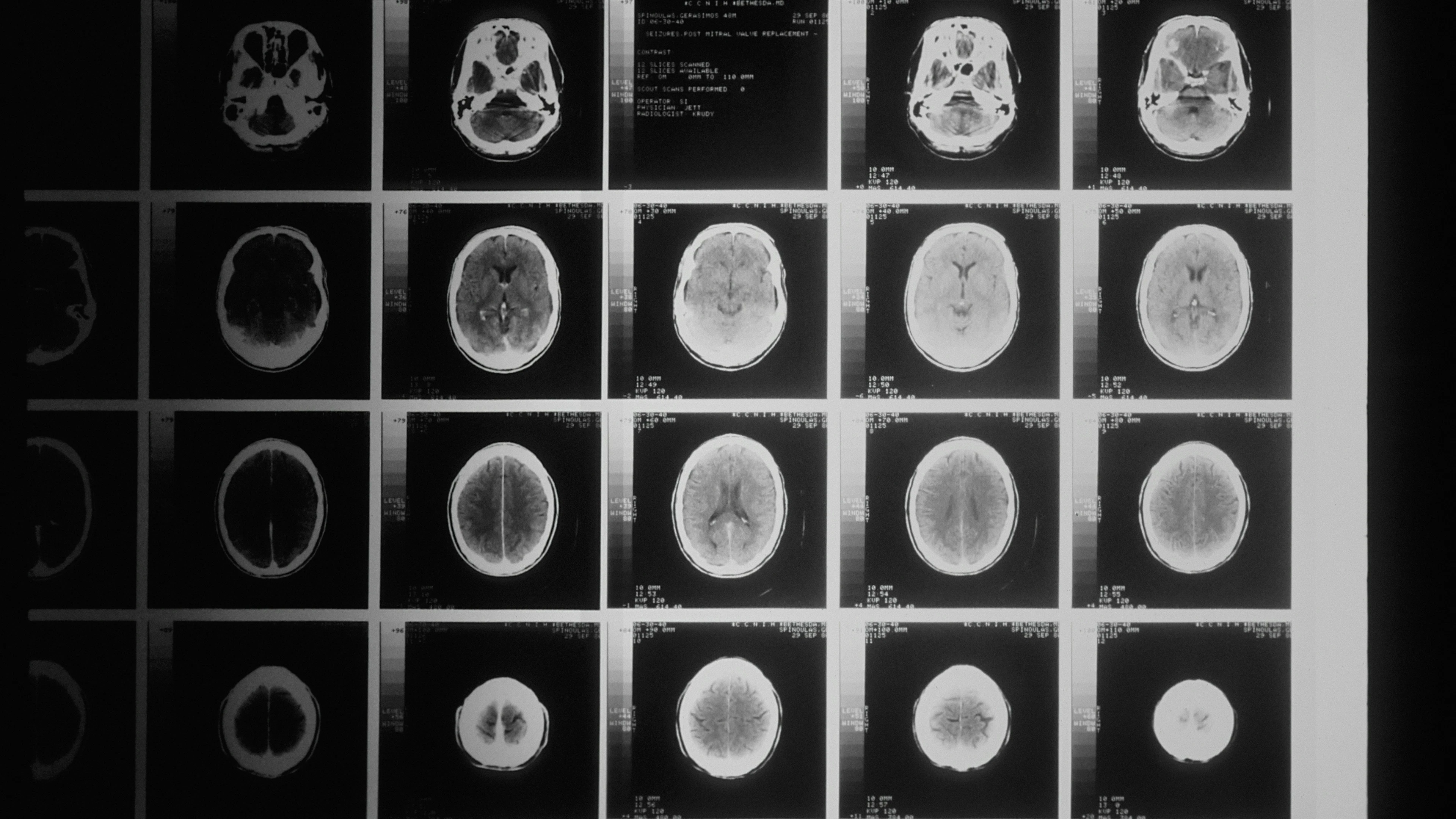 Nieuw mRNA-kankervaccin activeert felle immuunrespons tegen kwaadaardige hersentumoren
