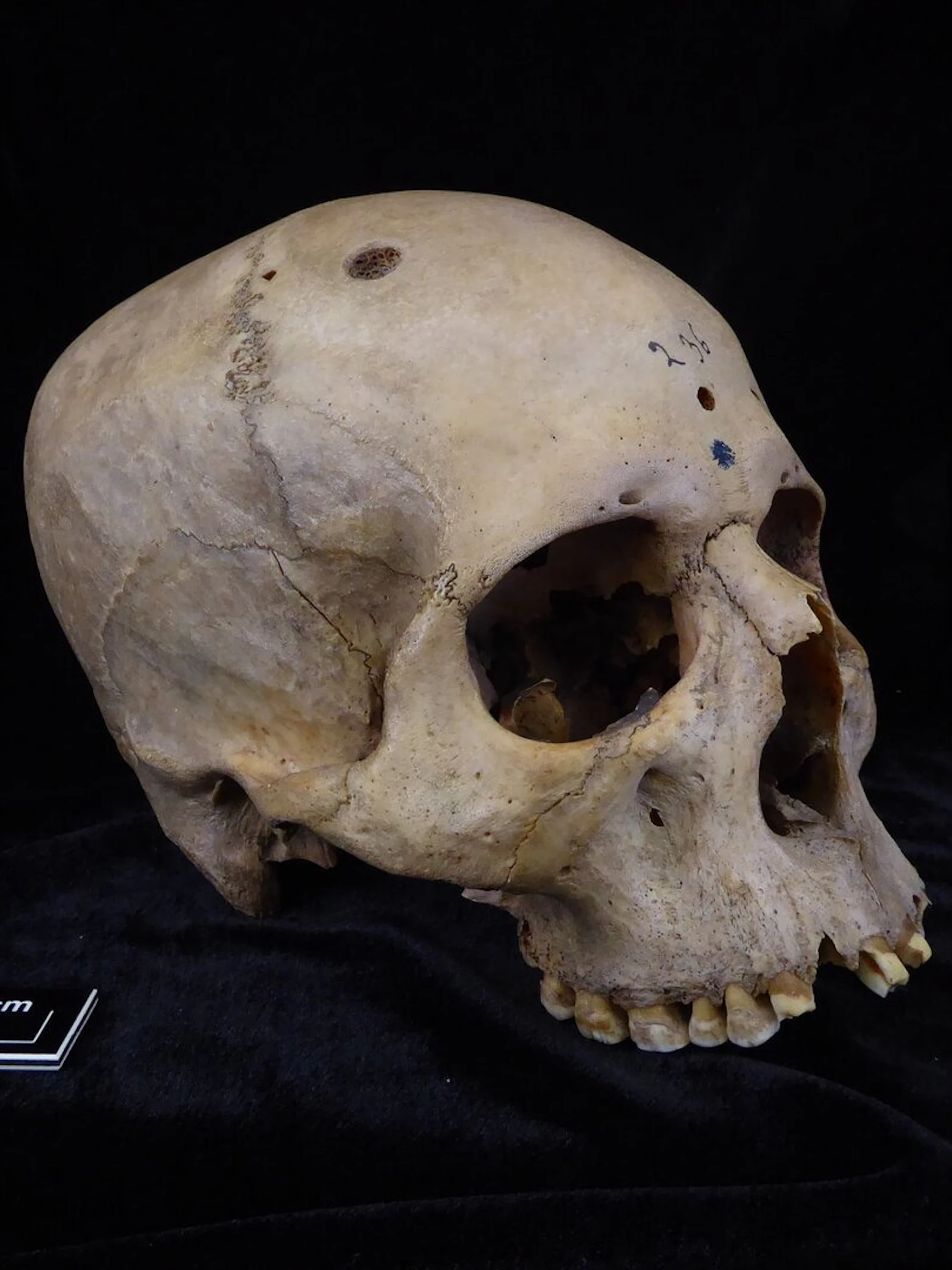 Oude Egyptische schedel vertoont sporen van kankeronderzoek