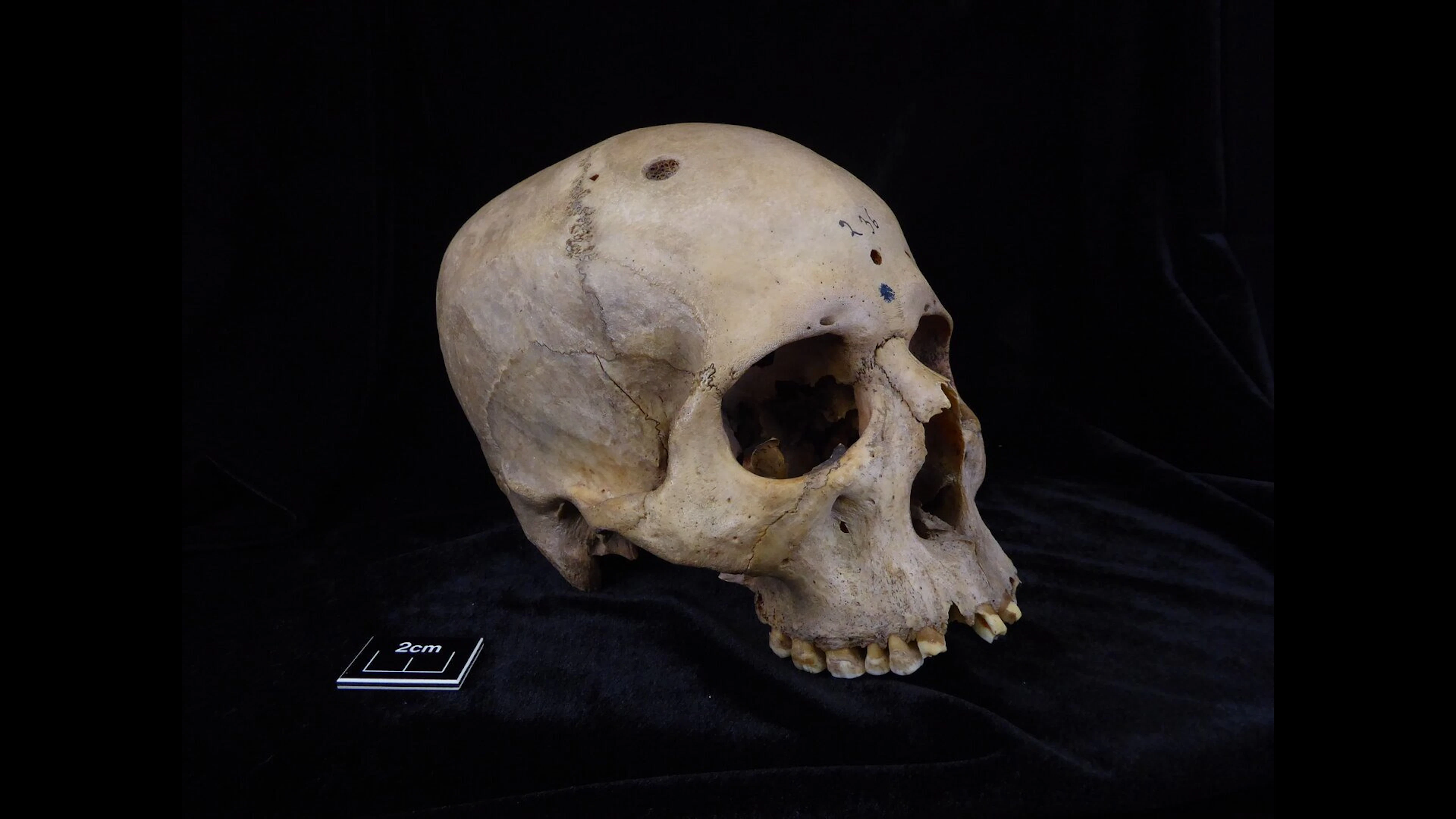 Oude Egyptische schedel vertoont sporen van kankeronderzoek