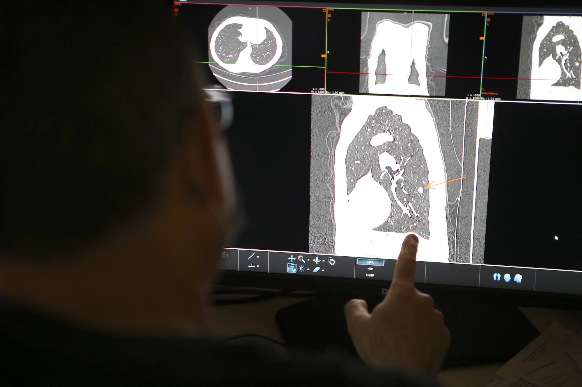 Huisartsen vinden longkankerscreening geen goede zaak