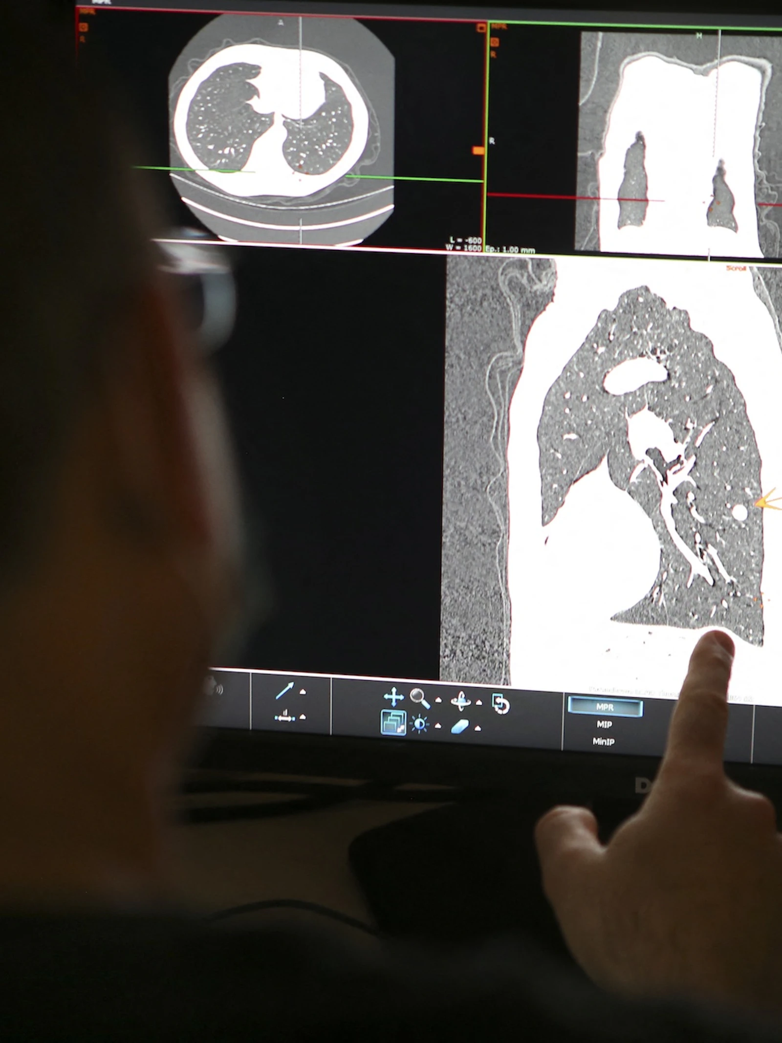 Huisartsen vinden longkankerscreening geen goede zaak