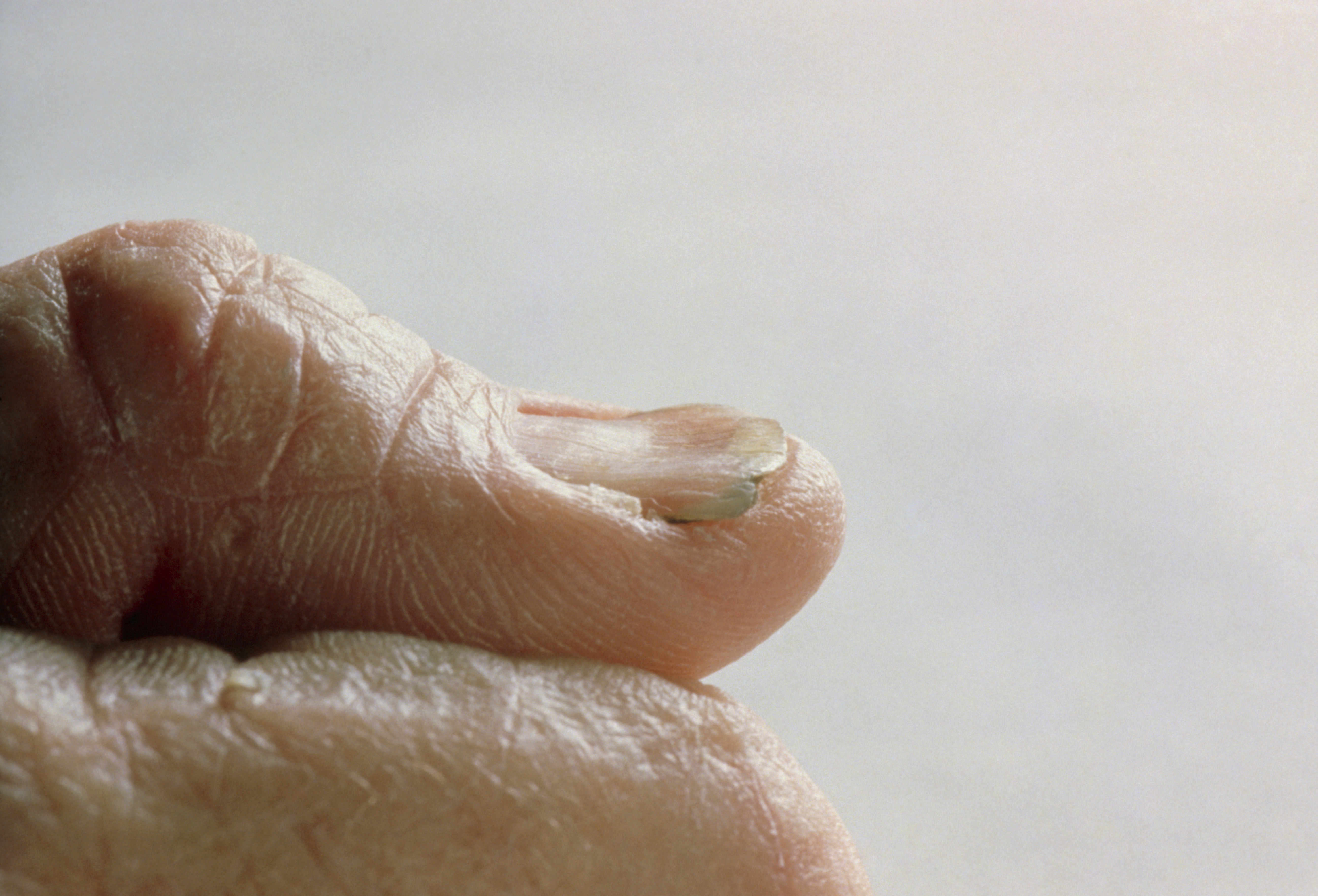 Wat je nagels je kunnen vertellen over je gezondheid