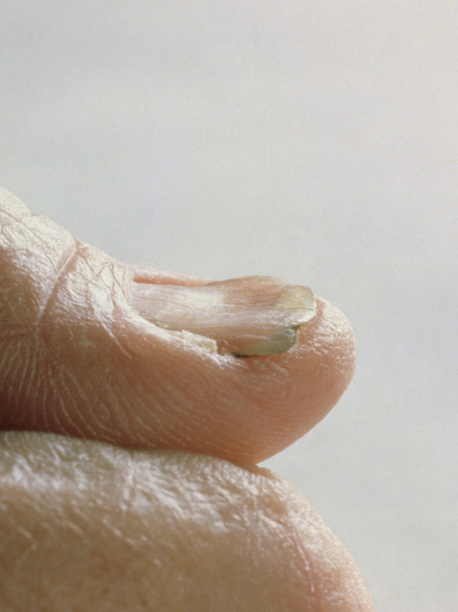 Wat je nagels je kunnen vertellen over je gezondheid