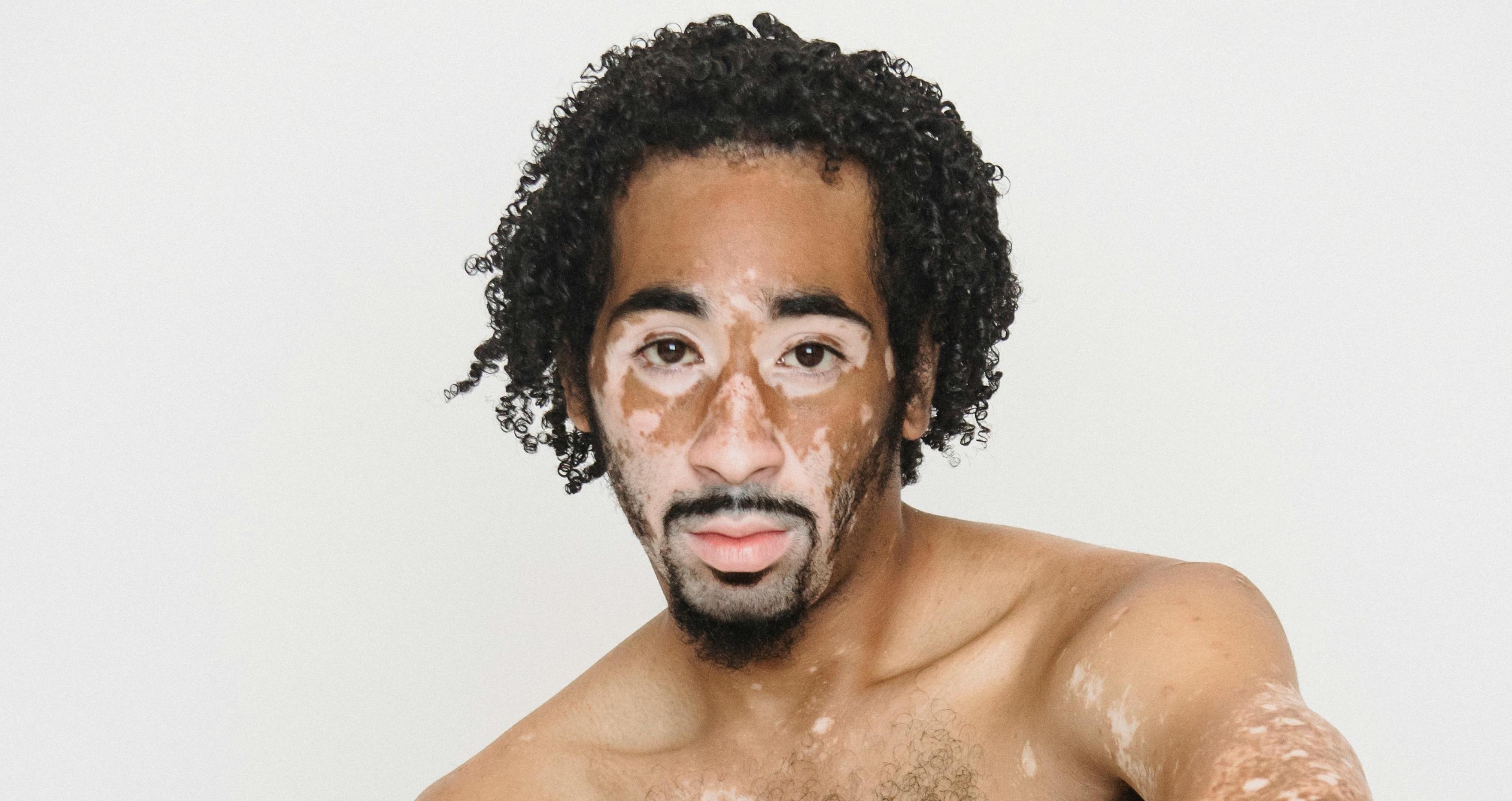 Wat is de oorzaak van vitiligo? Nieuwe studie wijst op een teveel aan enzym