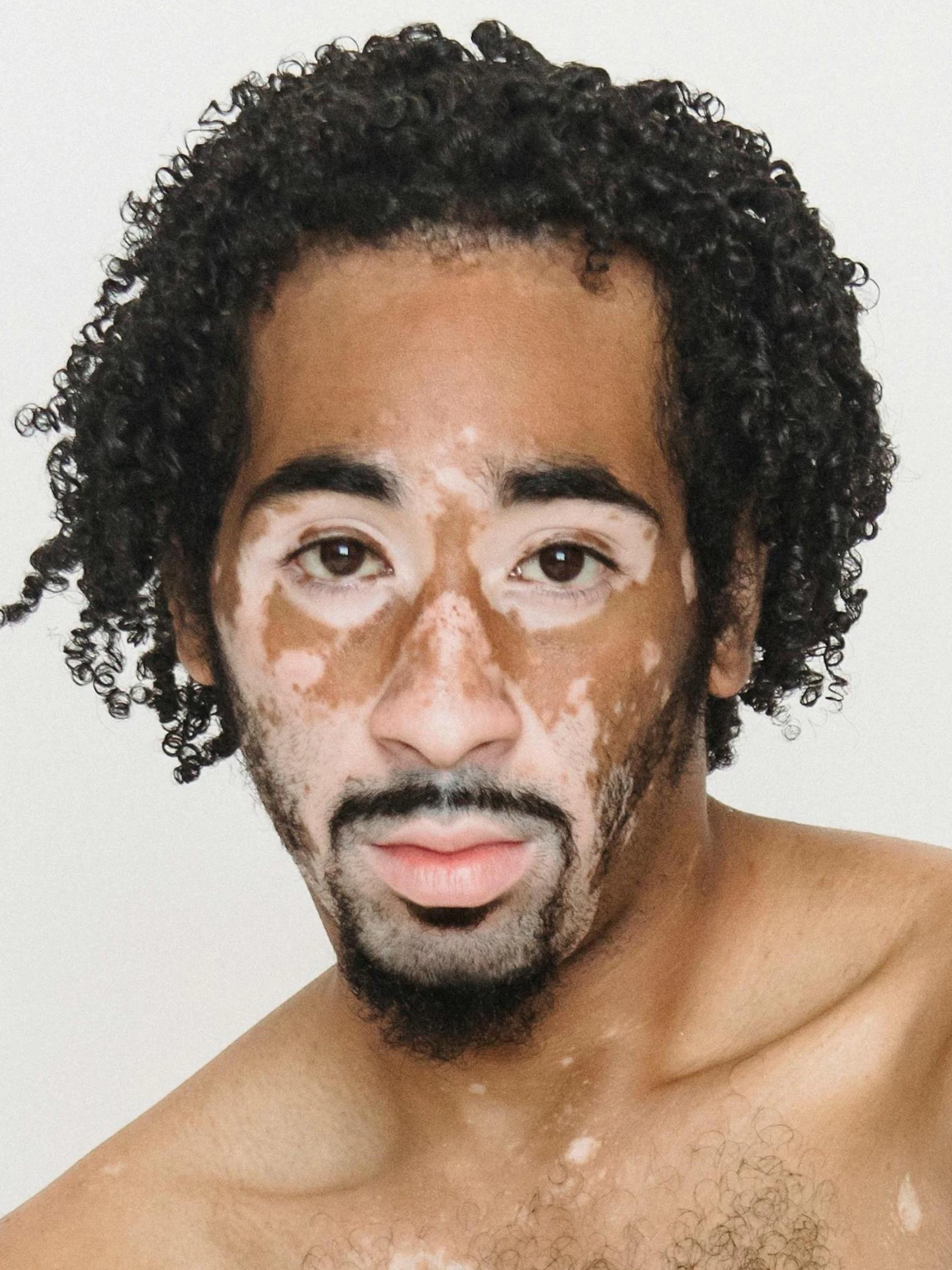 Wat is de oorzaak van vitiligo? Nieuwe studie wijst op een teveel aan enzym