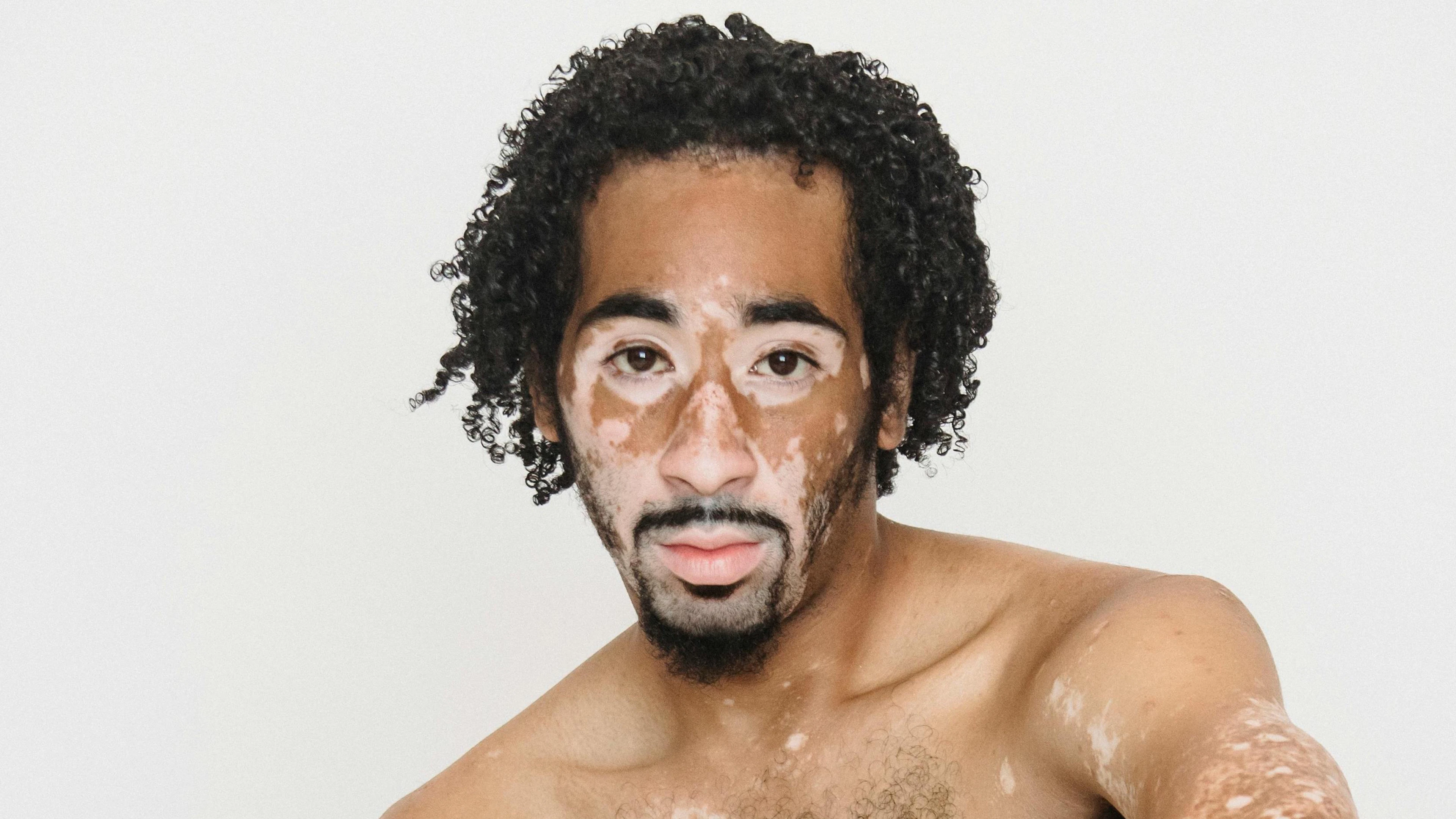 Wat is de oorzaak van vitiligo? Nieuwe studie wijst op een teveel aan enzym