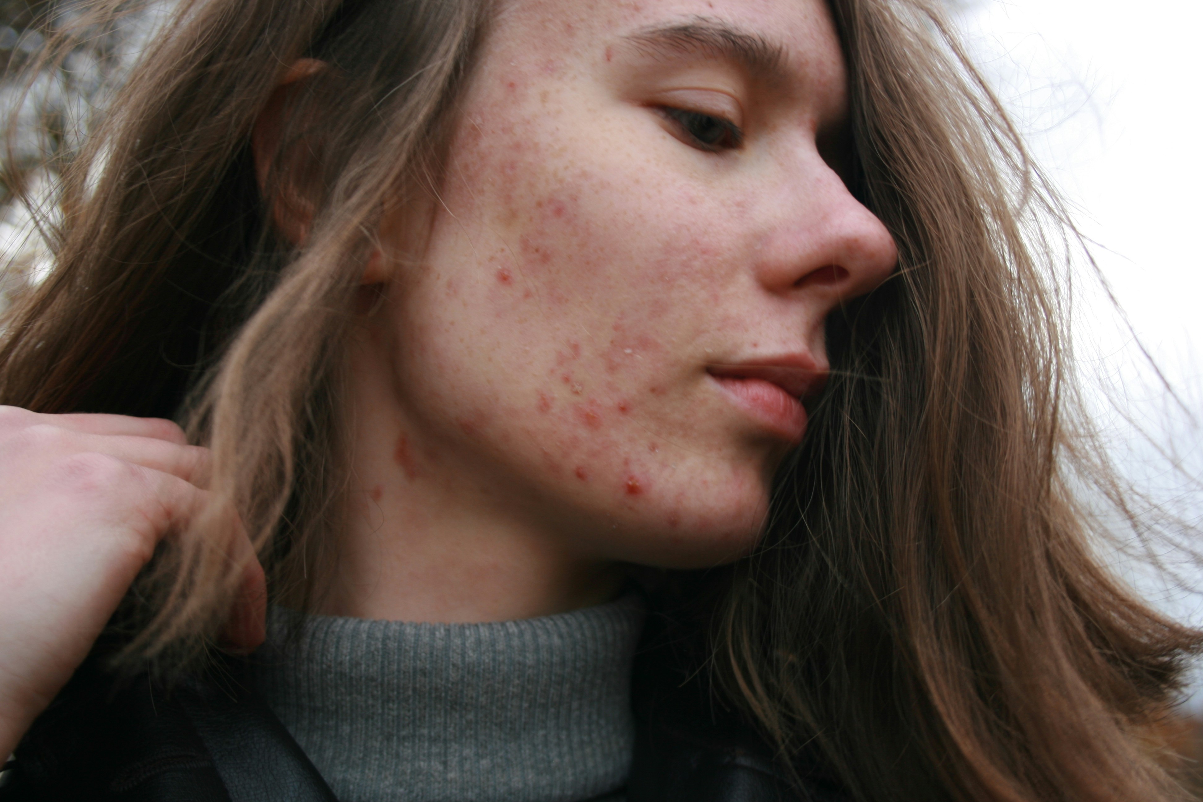 Helpt ledlicht tegen acne?