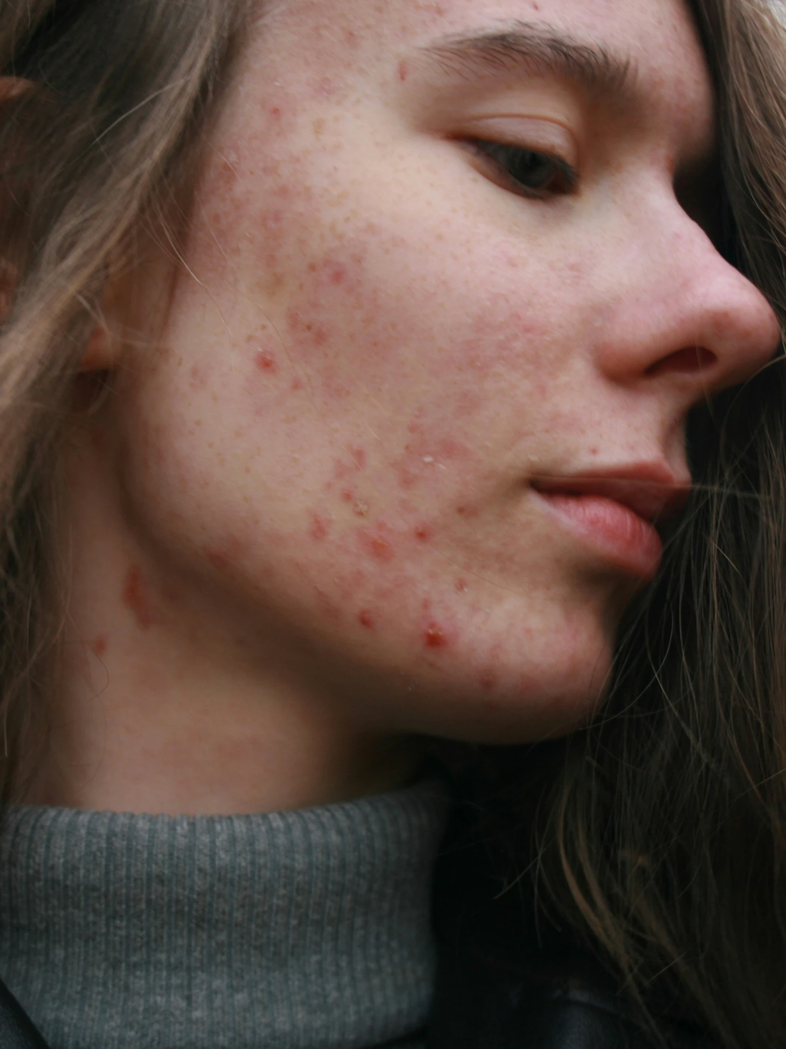 Helpt ledlicht tegen acne?