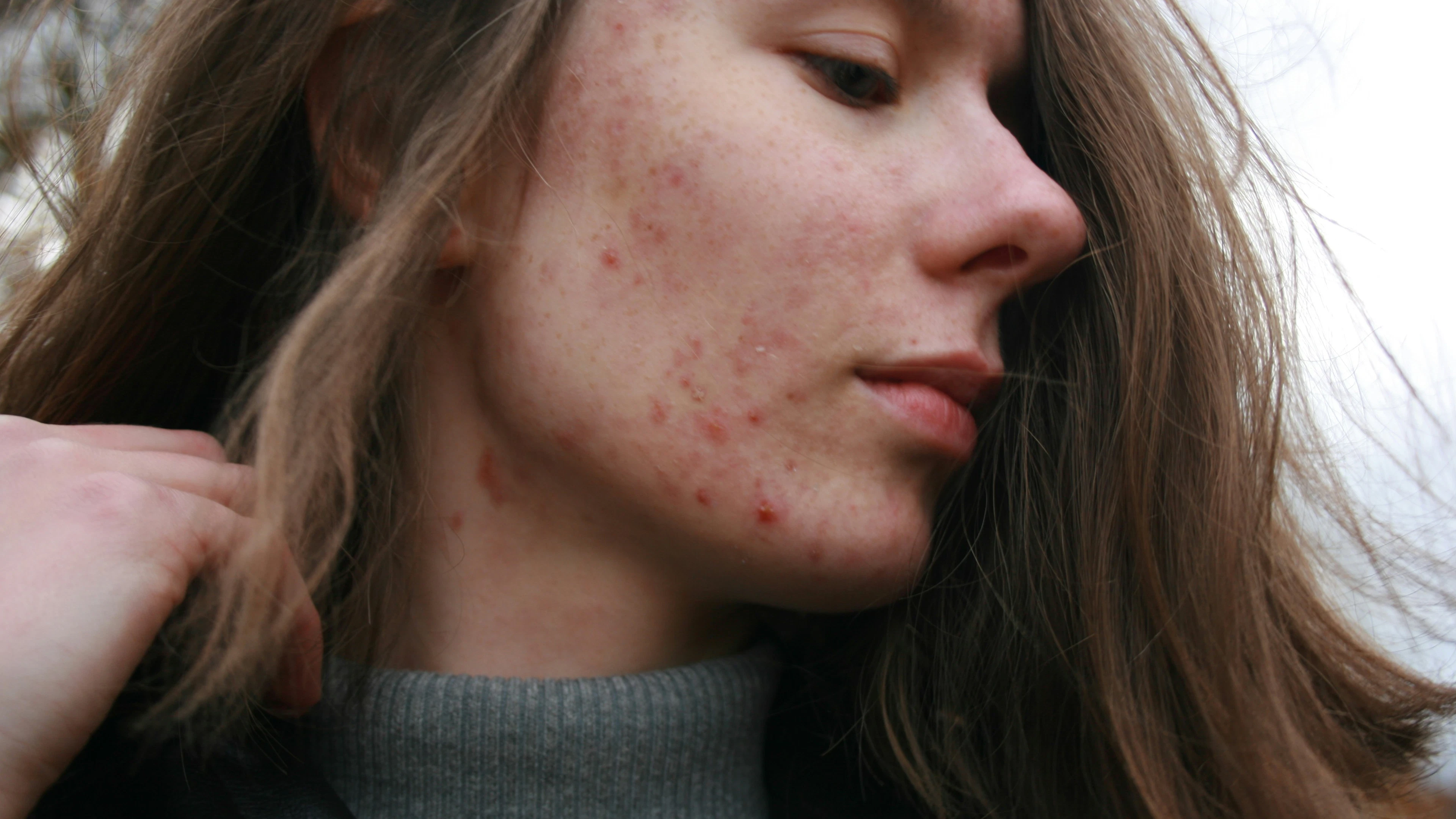Helpt ledlicht tegen acne?