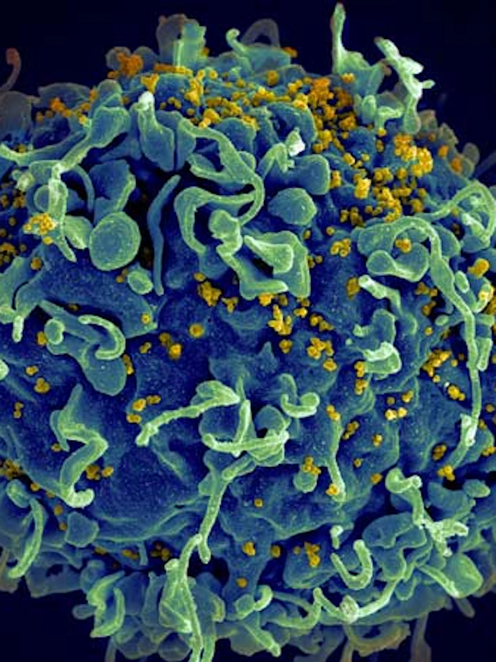 Nieuwe behandeling maakt hiv-virus wellicht definitief onschadelijk
