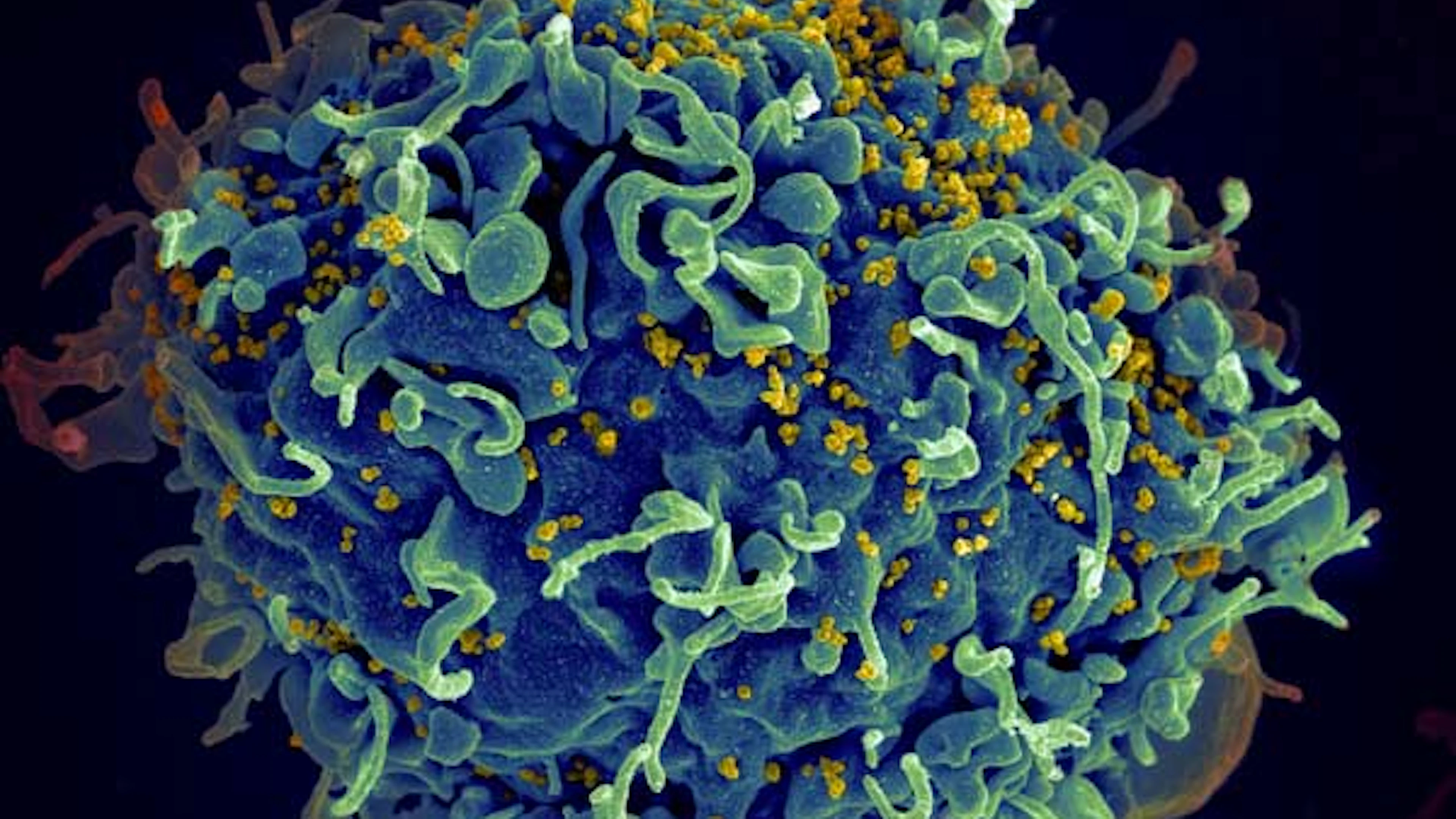 Nieuwe behandeling maakt hiv-virus wellicht definitief onschadelijk