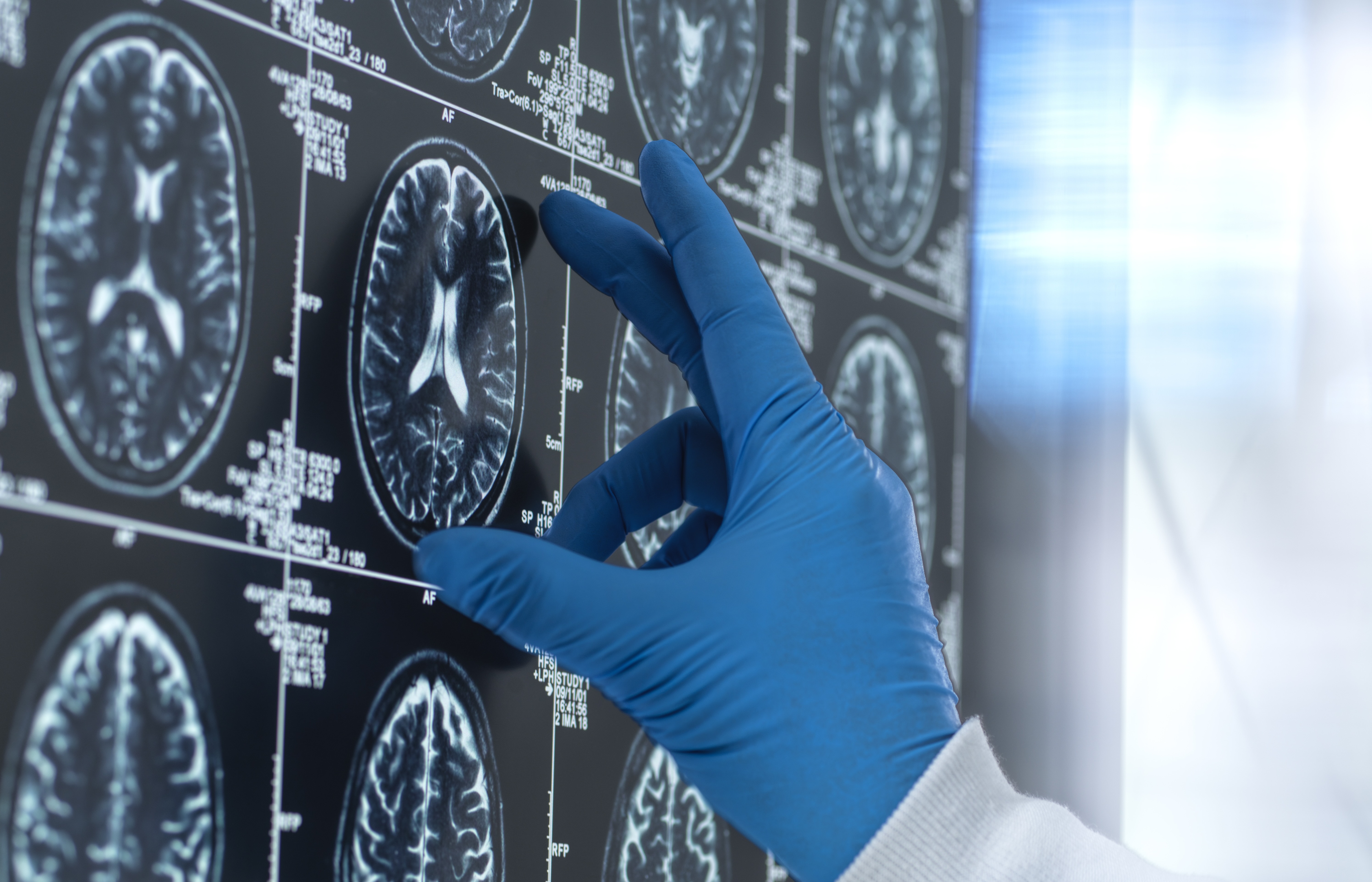 Kunnen sommige kankermedicijnen ook alzheimer verslaan?